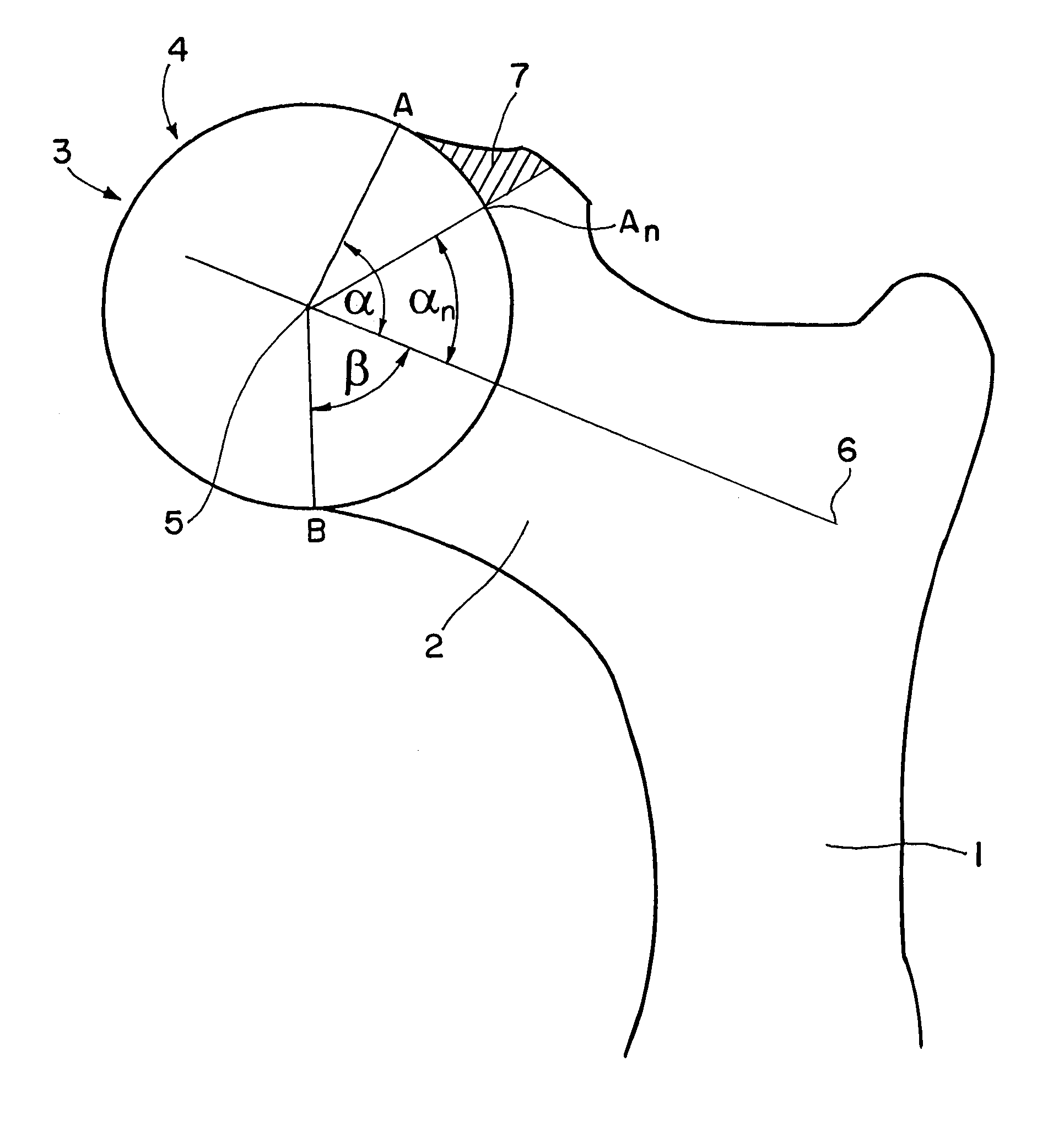 Computer-assisted planning method for correcting changes in the shape of joint bones