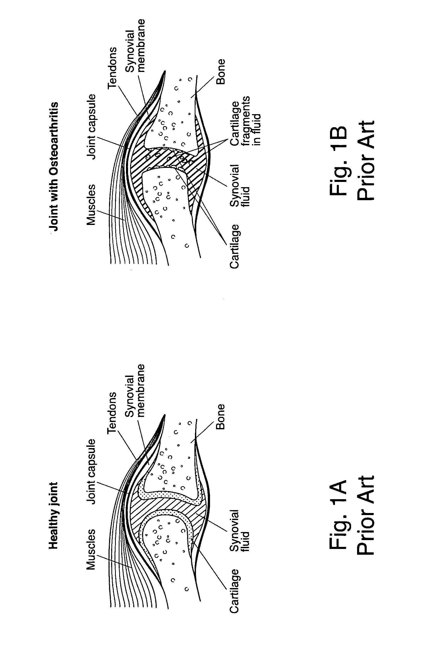 Method for treating cartilage defects
