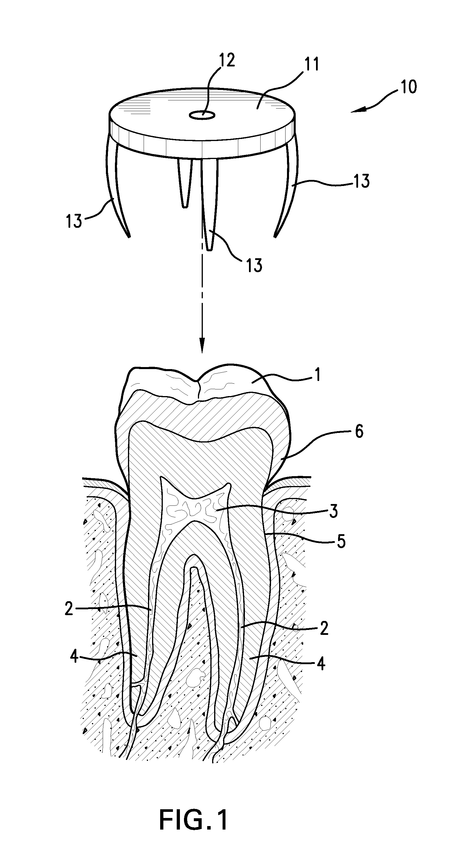 Device and method for locating a pulp chamber in a tooth