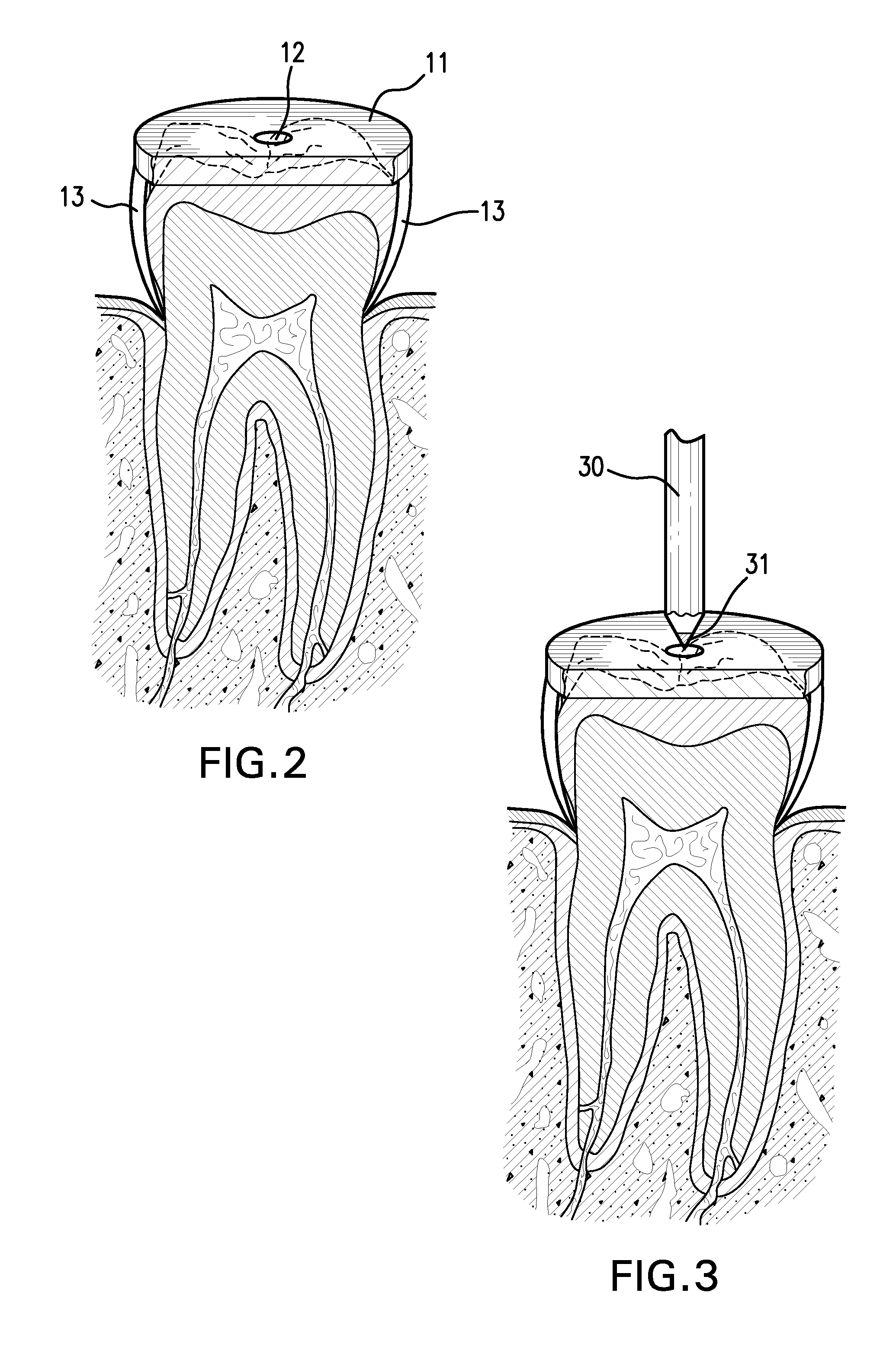 Device and method for locating a pulp chamber in a tooth
