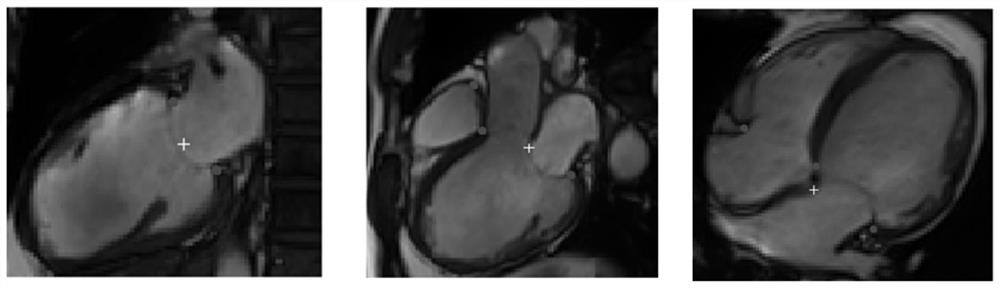 Heart model parameter identification method based on atrioventricular plane longitudinal displacement