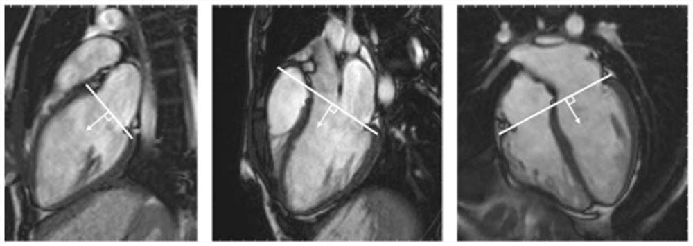 Heart model parameter identification method based on atrioventricular plane longitudinal displacement