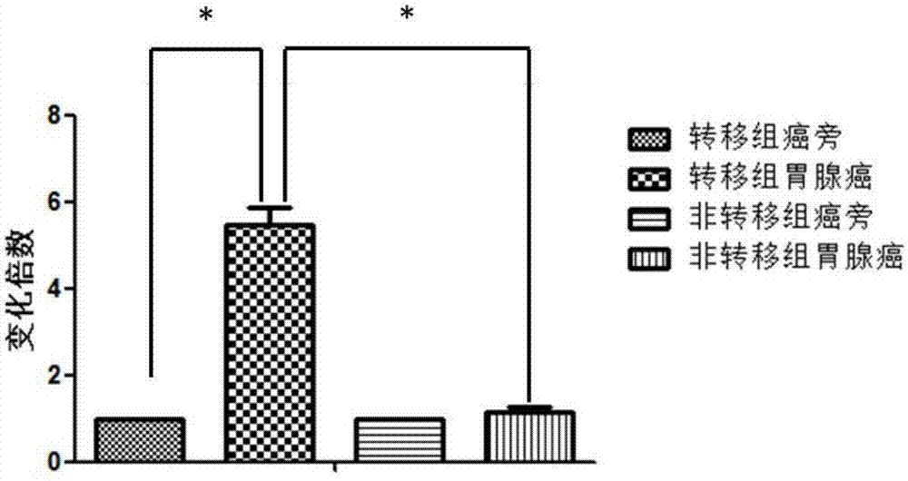 Biomarker for diagnosing and treating gastric adenocarcinoma metastasis