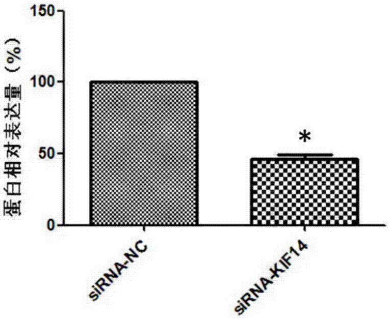 Biomarker for diagnosing and treating gastric adenocarcinoma metastasis