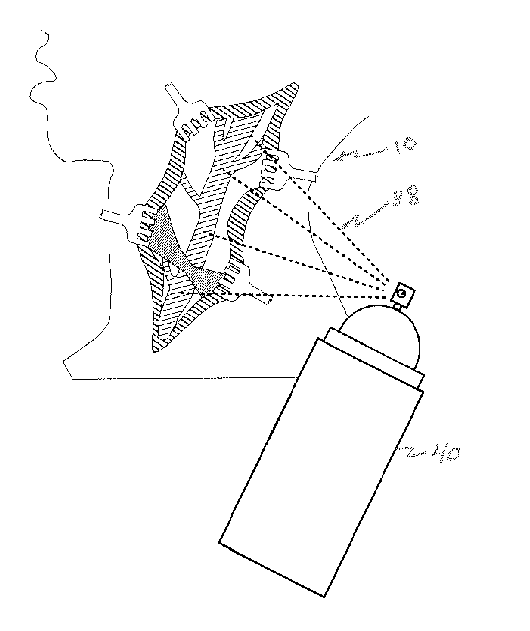 Implantable drug eluting system and method of use