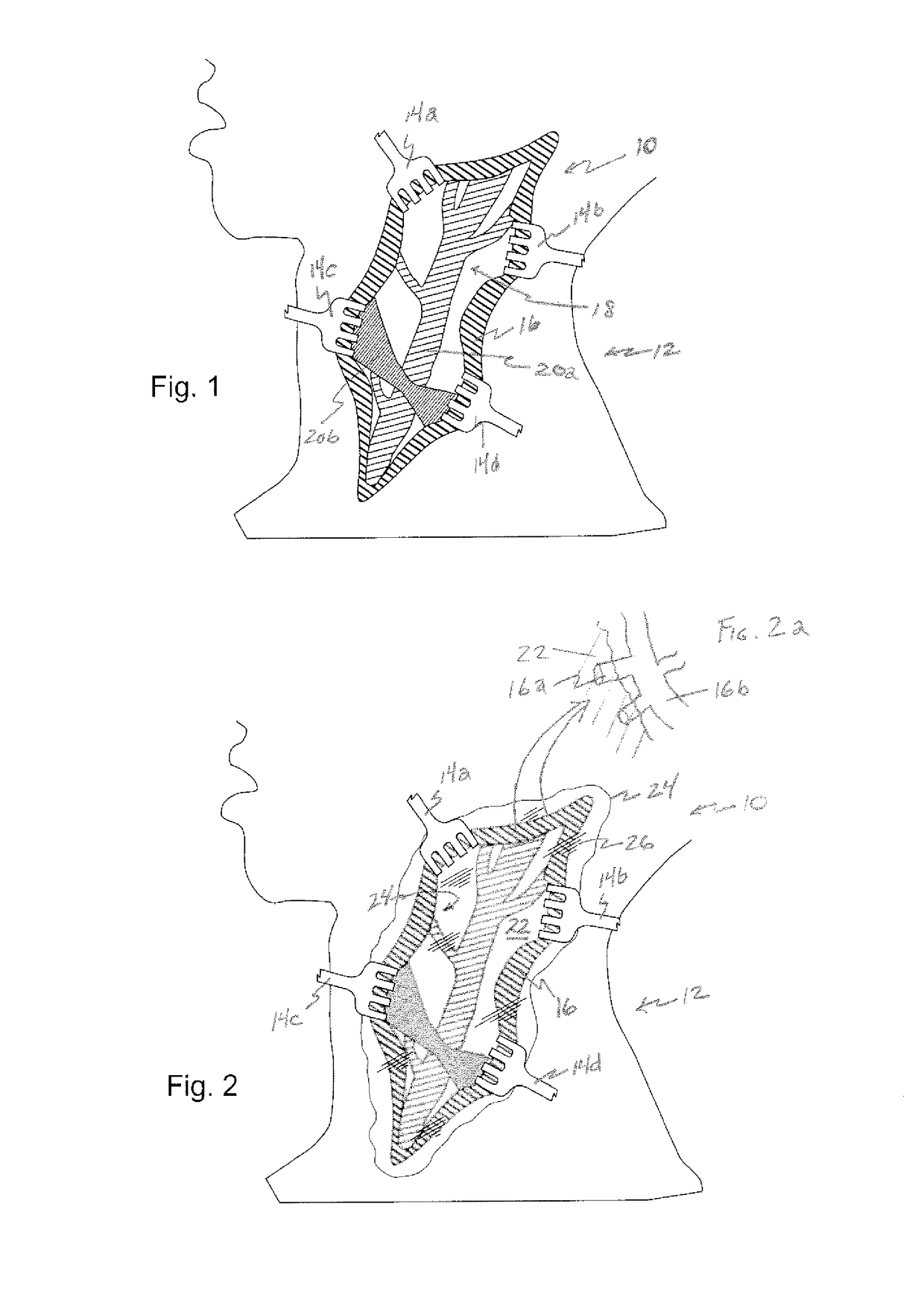 Implantable drug eluting system and method of use