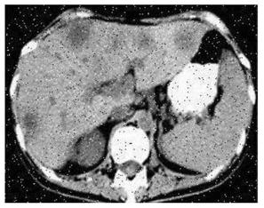 A medical image segmentation method for liver model in robot virtual training system