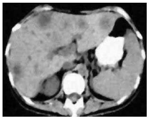 A medical image segmentation method for liver model in robot virtual training system