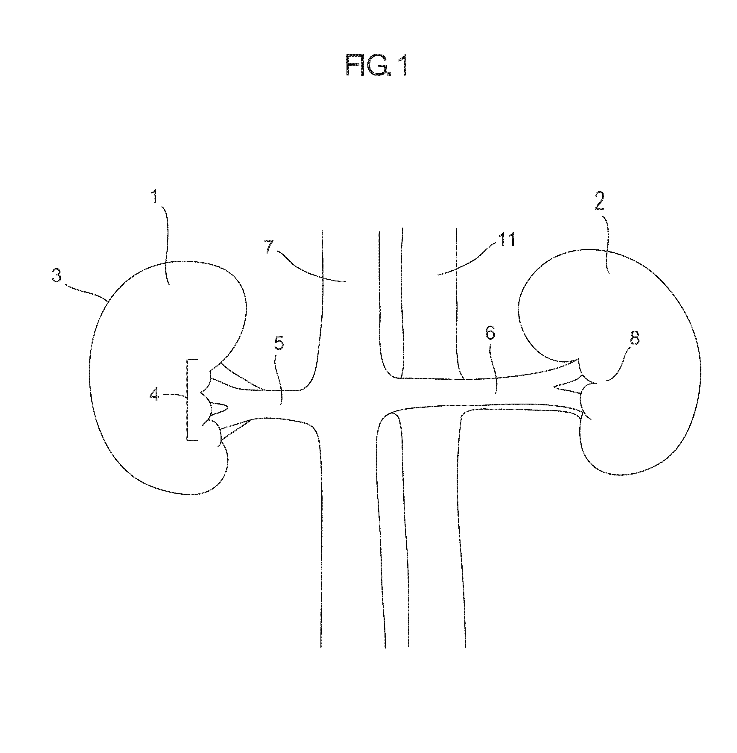 Devices And Methods For Detection And Treatment Of The Aorticorenal Ganglion