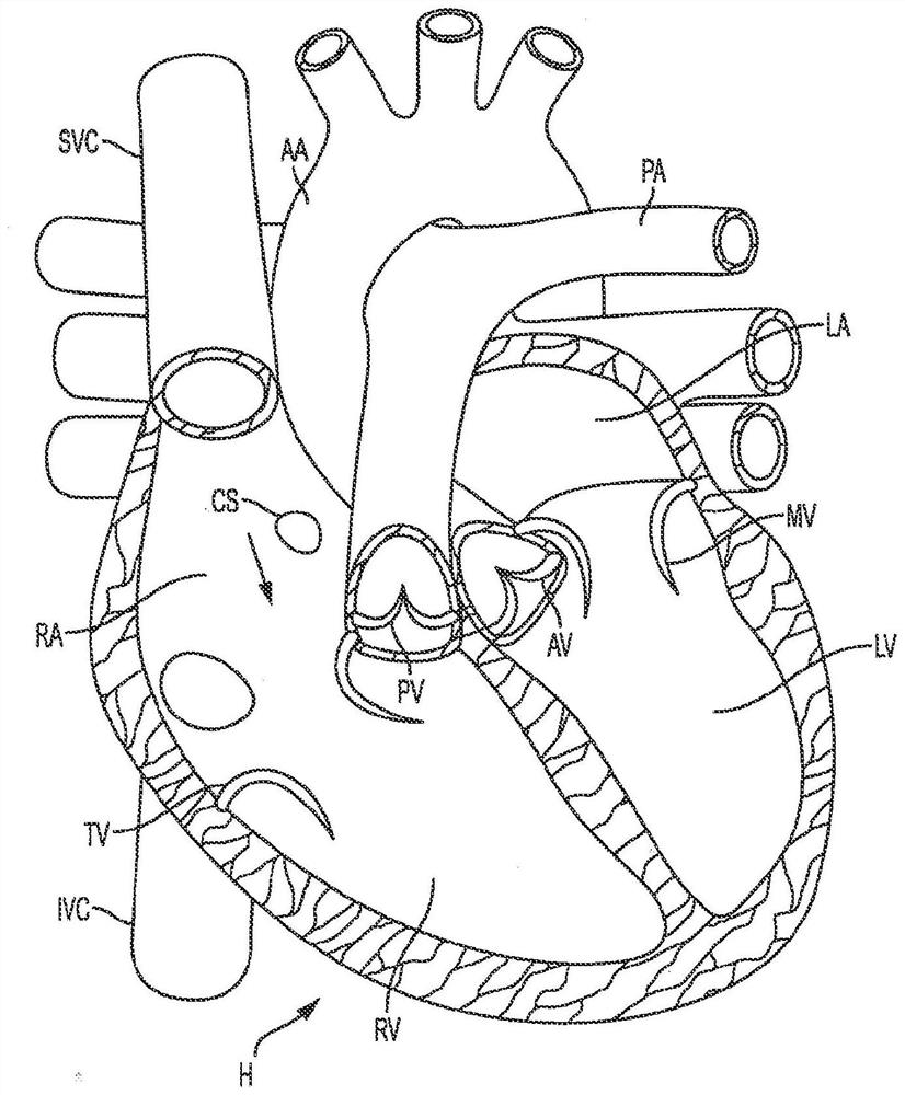 Unidirectional valvular implant - Eureka | Patsnap develop intelligence ...