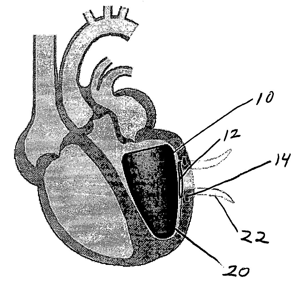 Method and devices for treating ischemic congestive heart failure