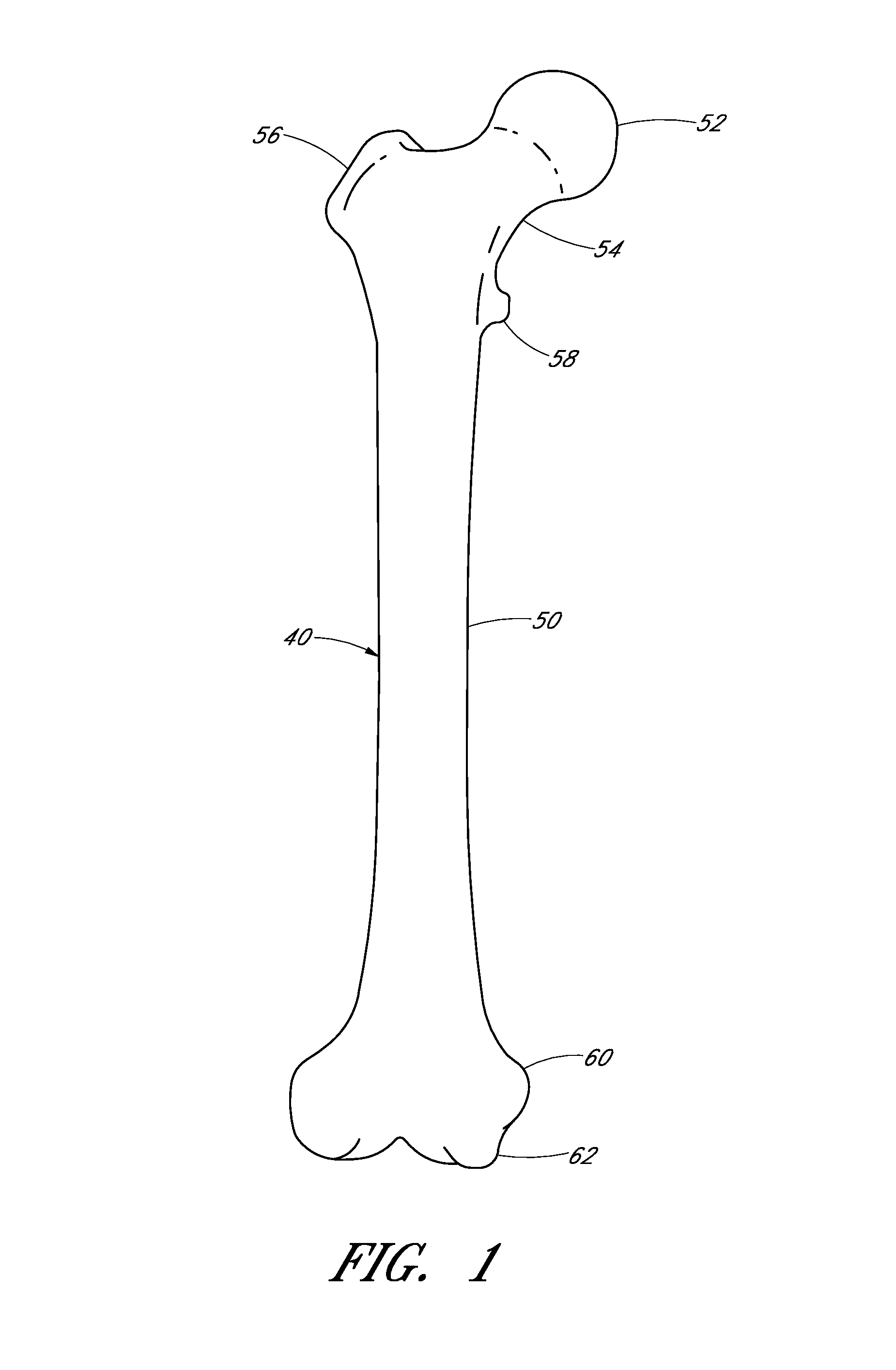 Intramedullary linkage device, system, and method for implantation