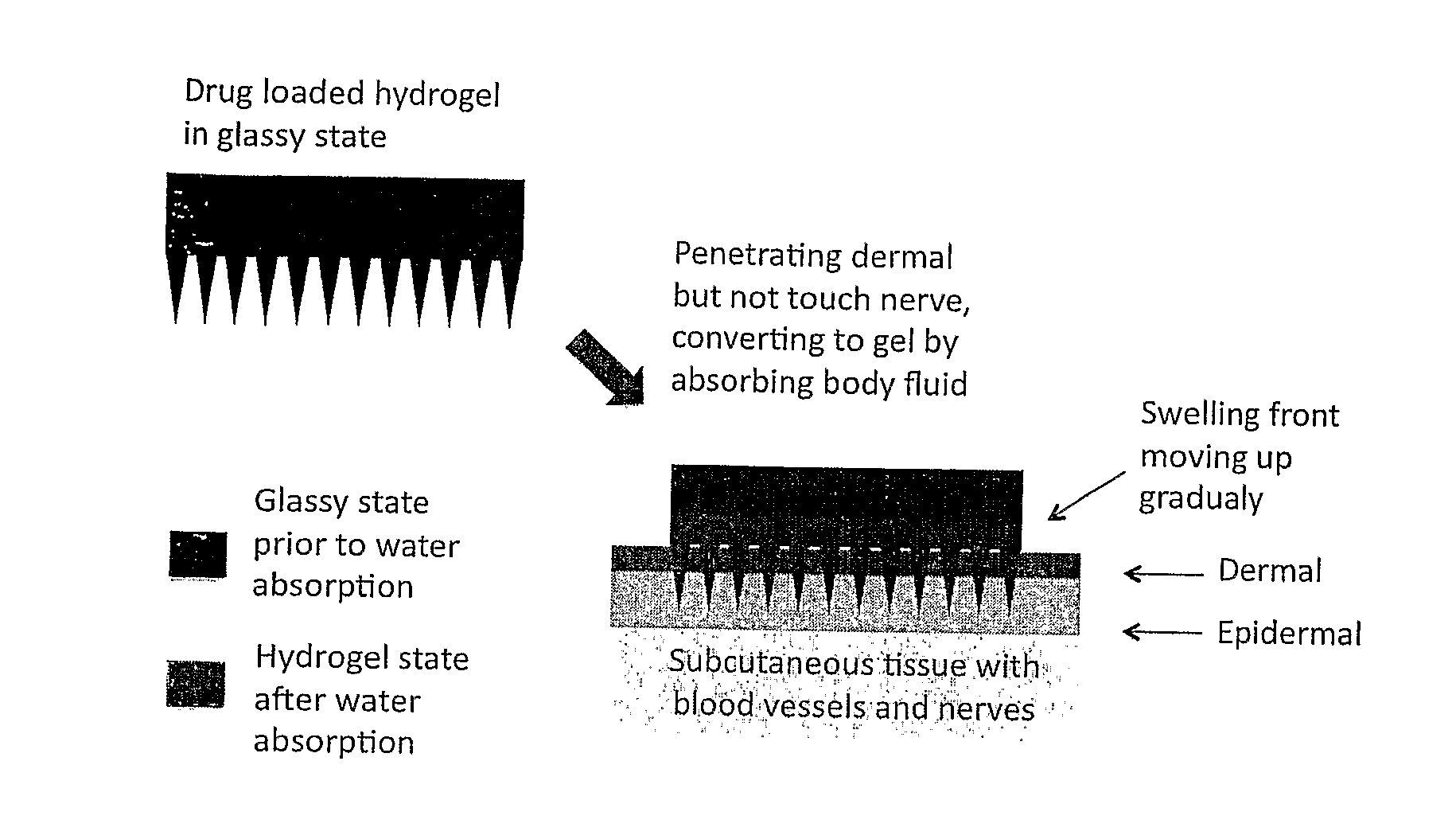 Phase-transition polymeric microneedles
