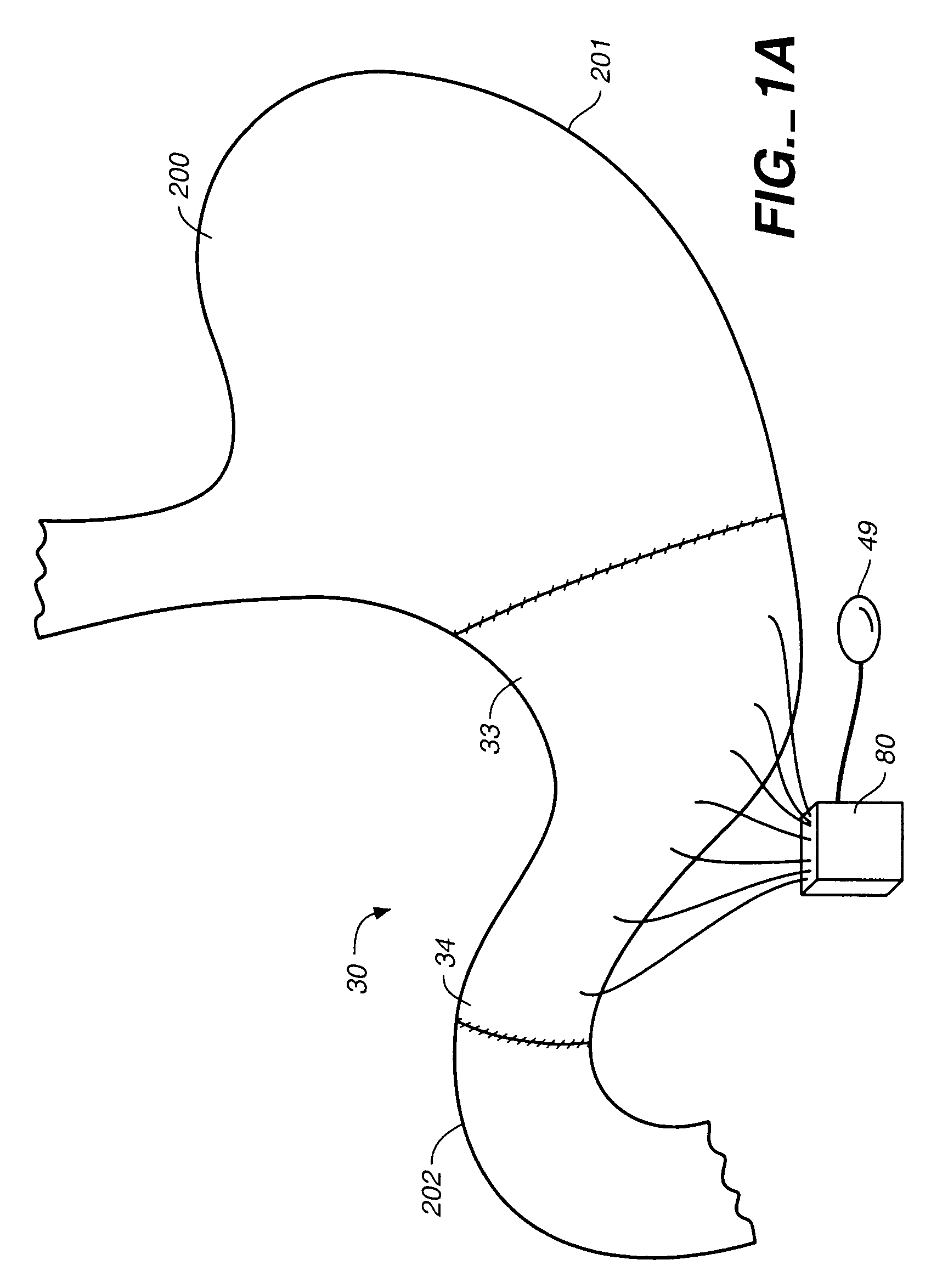 Stomach peristalsis device and method