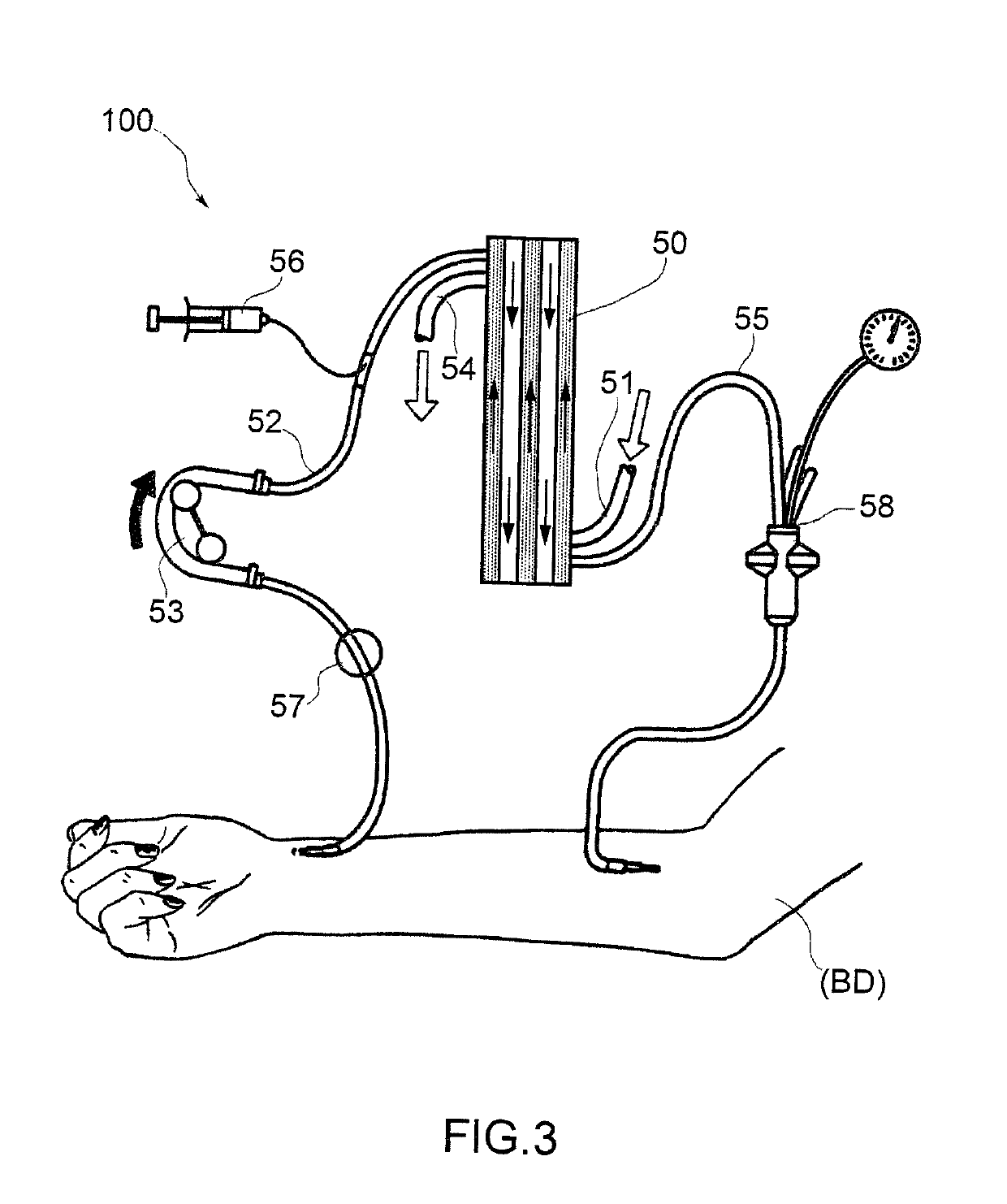 Differential flow-meter for measuring the weight loss in haemodialysis treatments