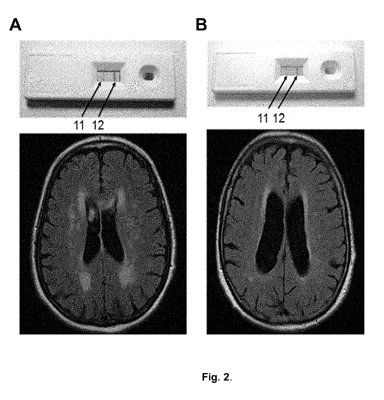 Diagnostic reagent kit for detecting chronic brain pathologies of ischemic genesis