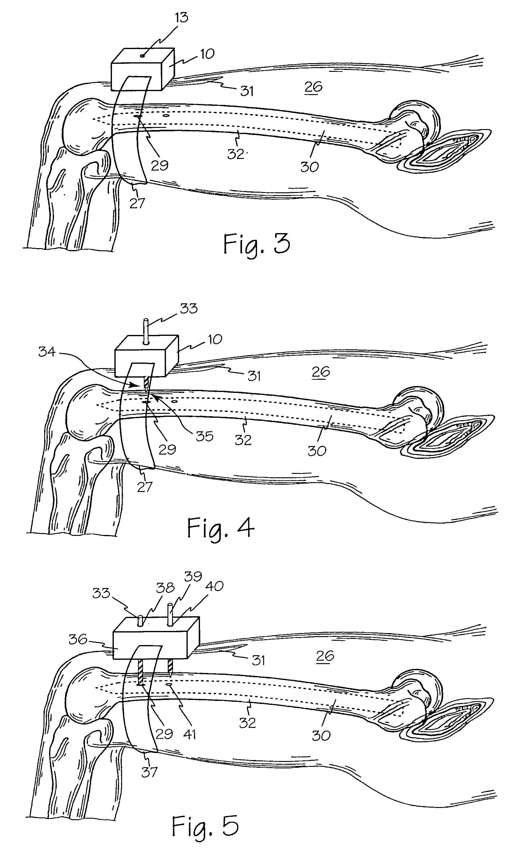 Method and apparatus for targeting blind holes in intramedullary rods