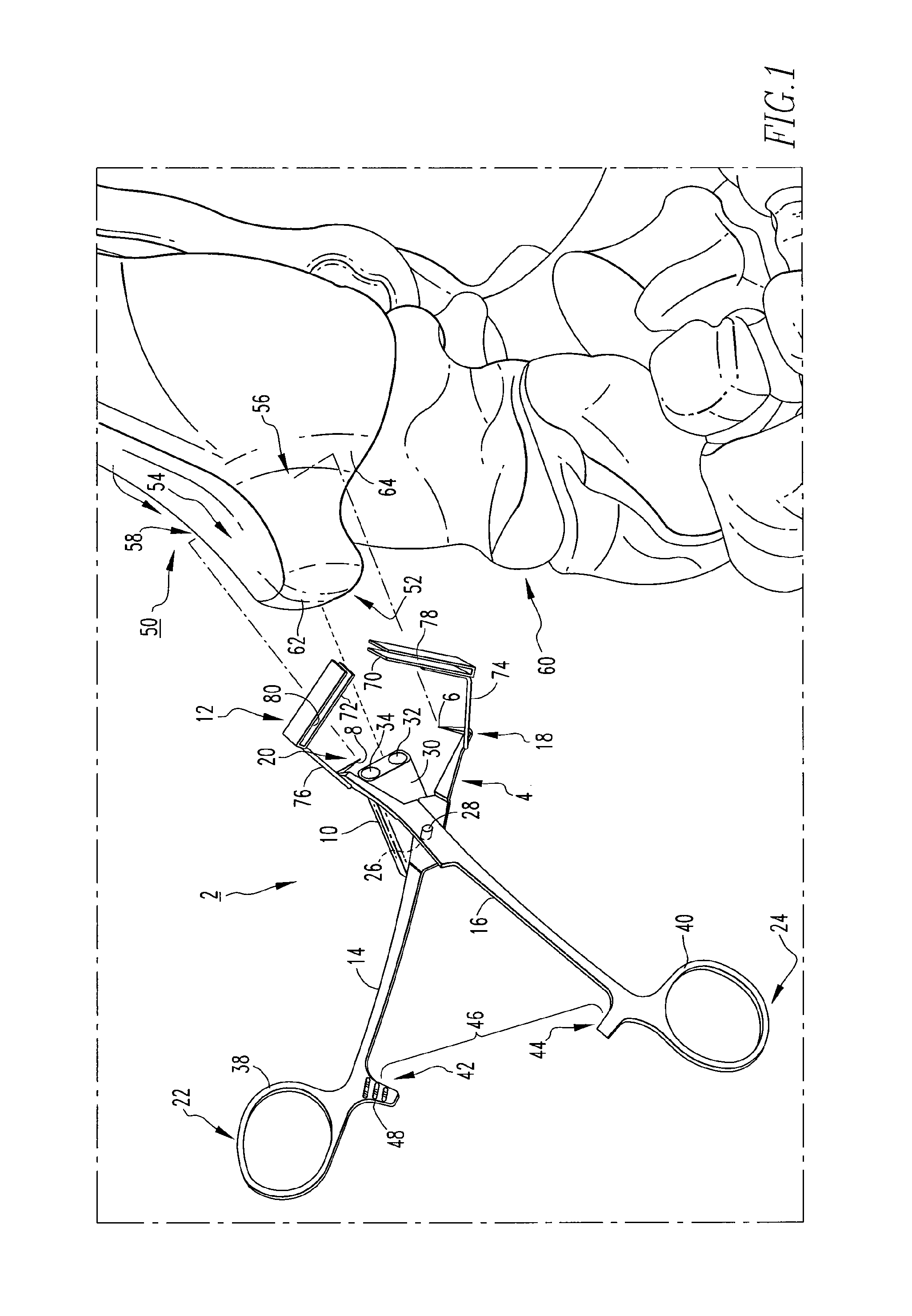 Osteotomy Guide and Method of Cutting the Medial Distal Tibia Employing the Same