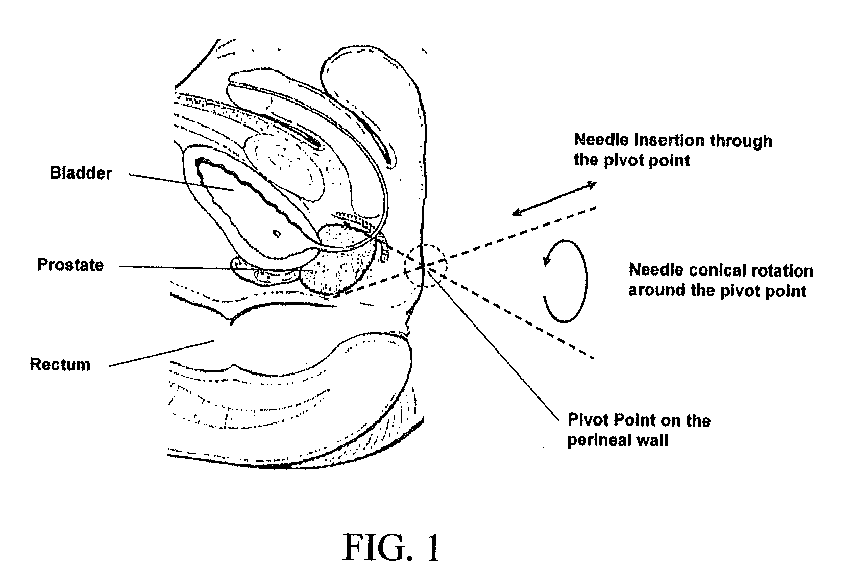 Apparatus and method for motorised placement of needle