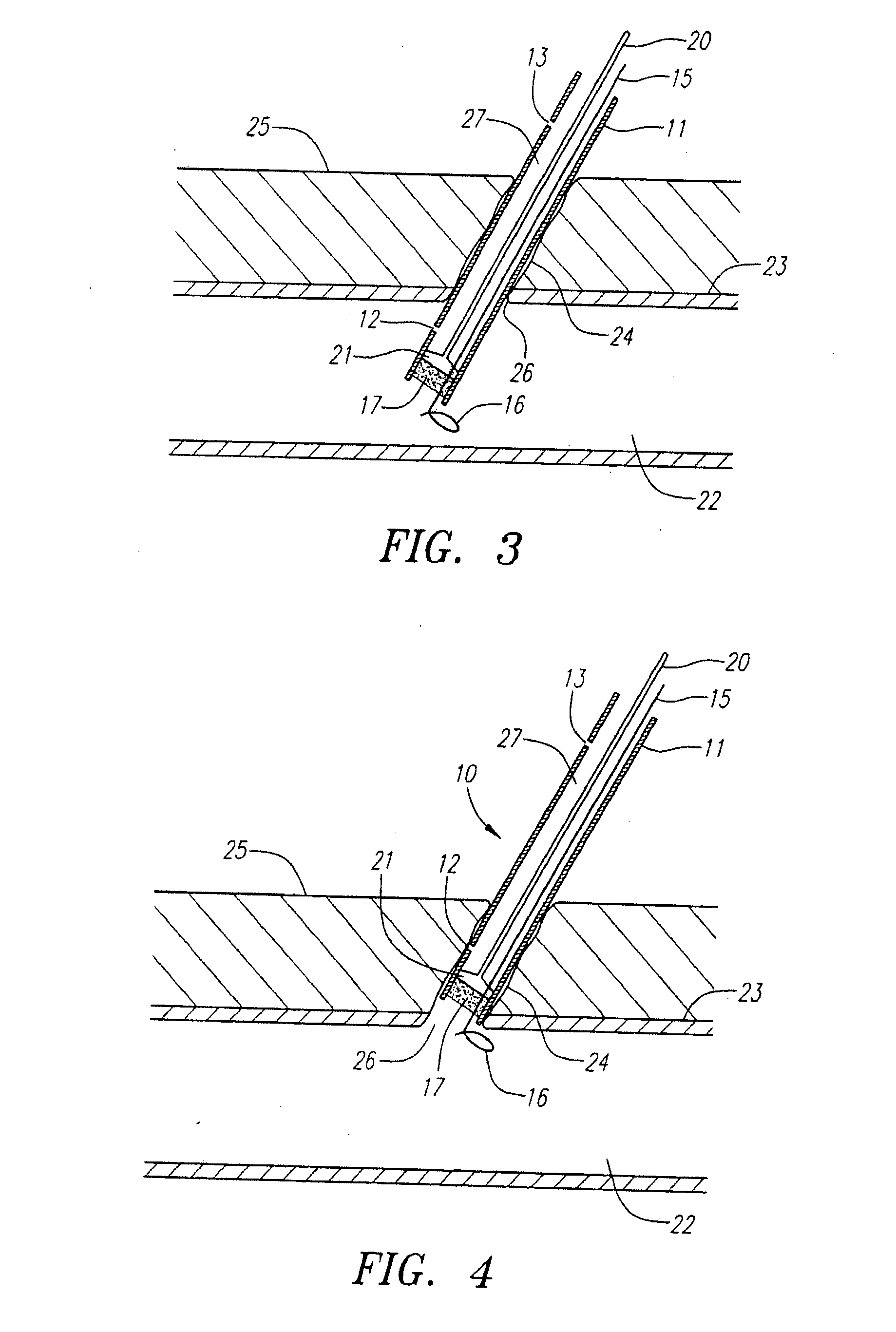 Locator and delivery device and method of use
