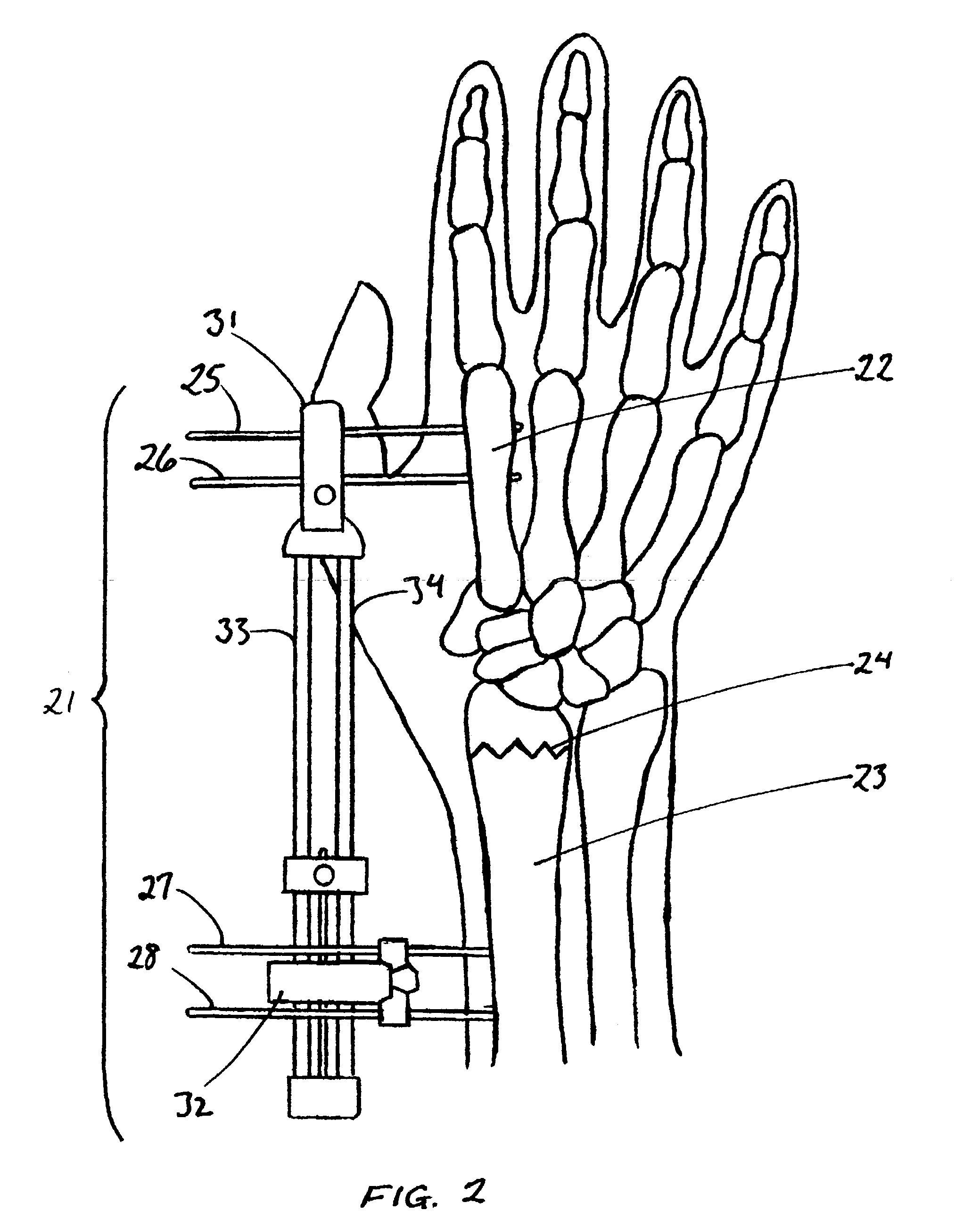 External fixator for colles' fracture