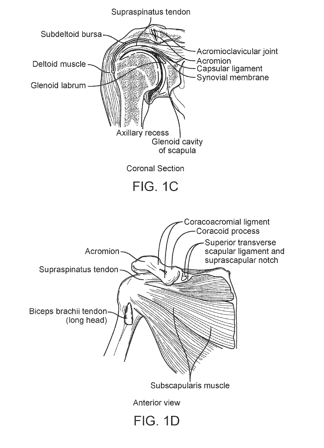 Method and apparatus for altering biomechanics of the shoulder