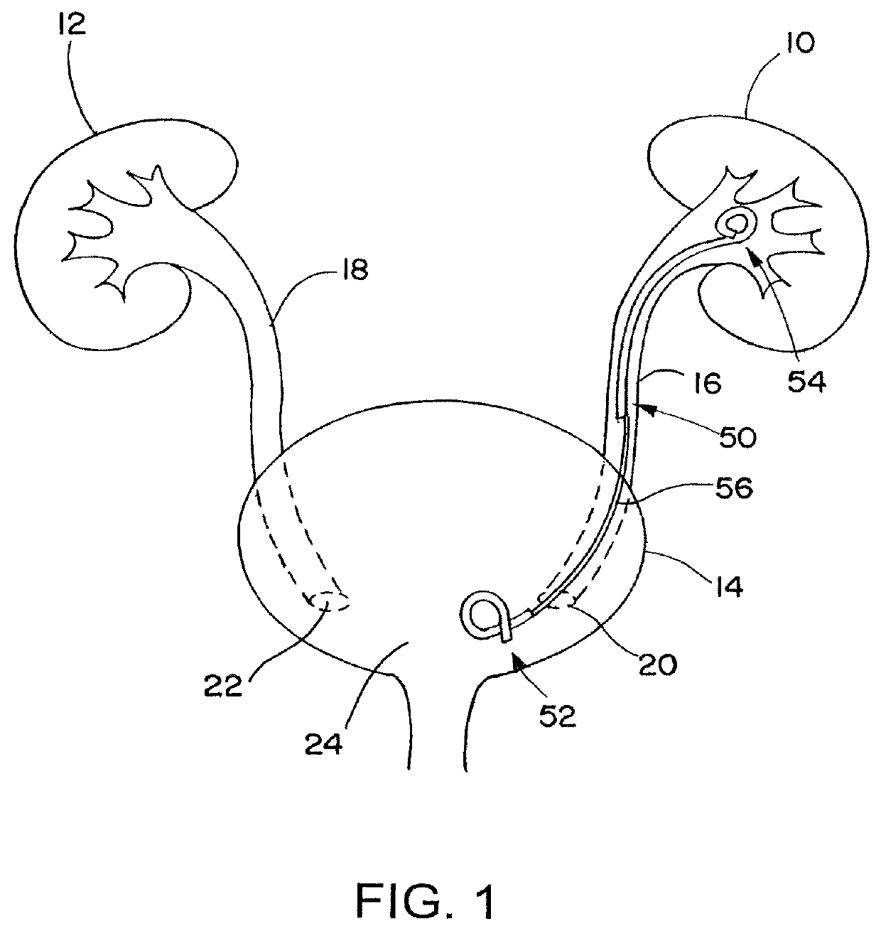 Ureteral stent for placement in a kidney and bladder