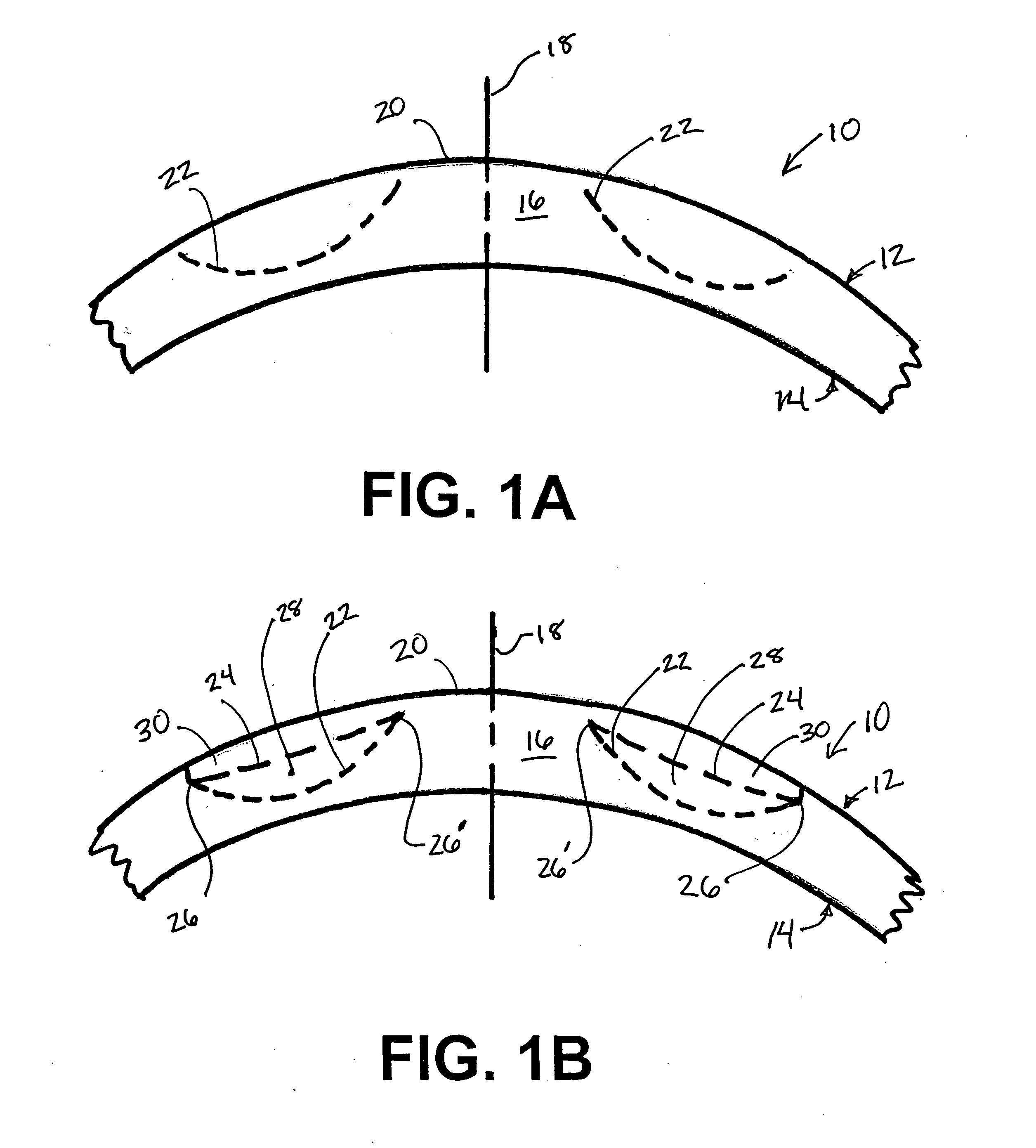 Method for correcting hyperopia and presbyopia using a laser and an inlay outside the visual axis of eye