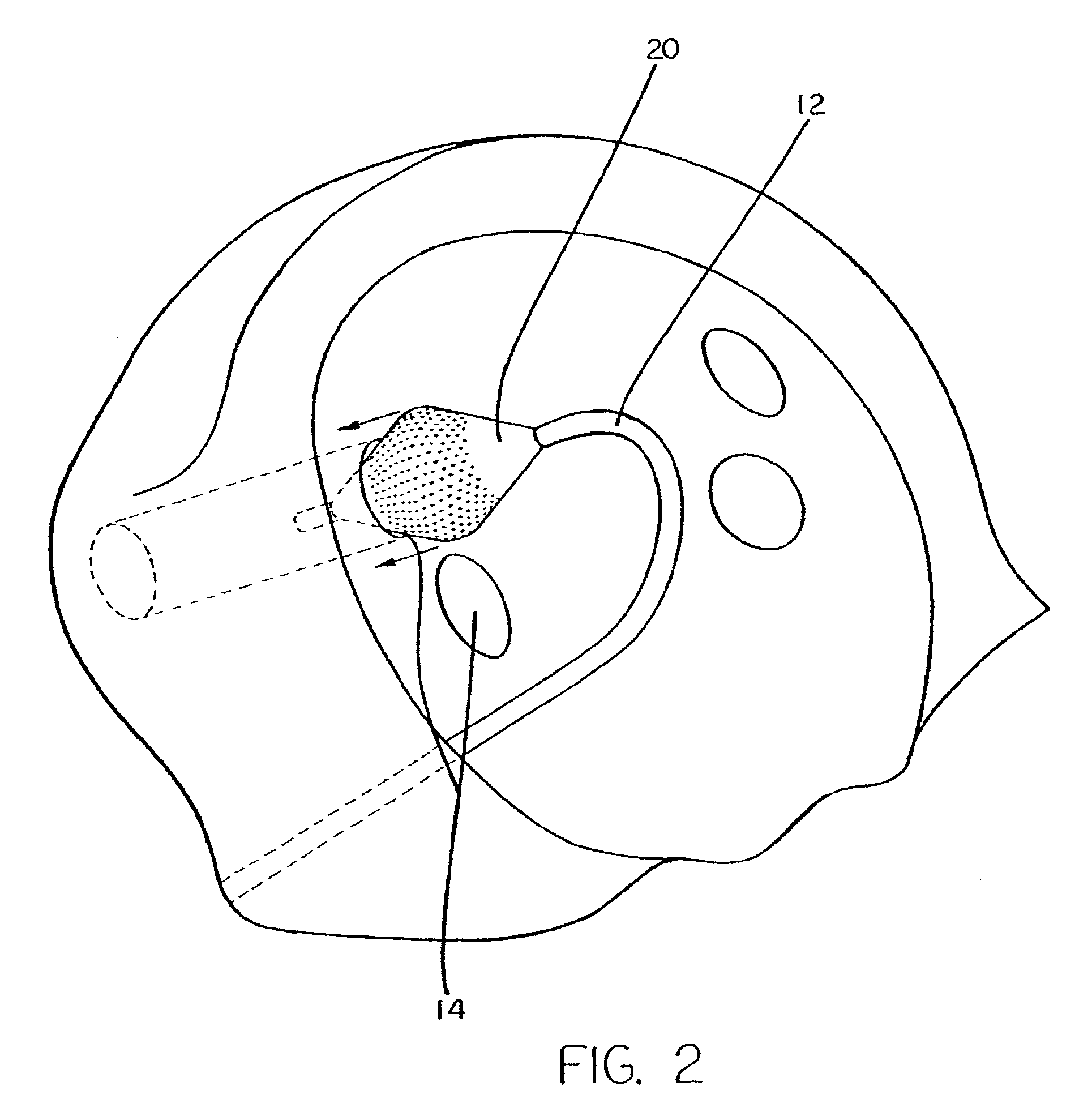 Process and device for the treatment of atrial arrhythmia