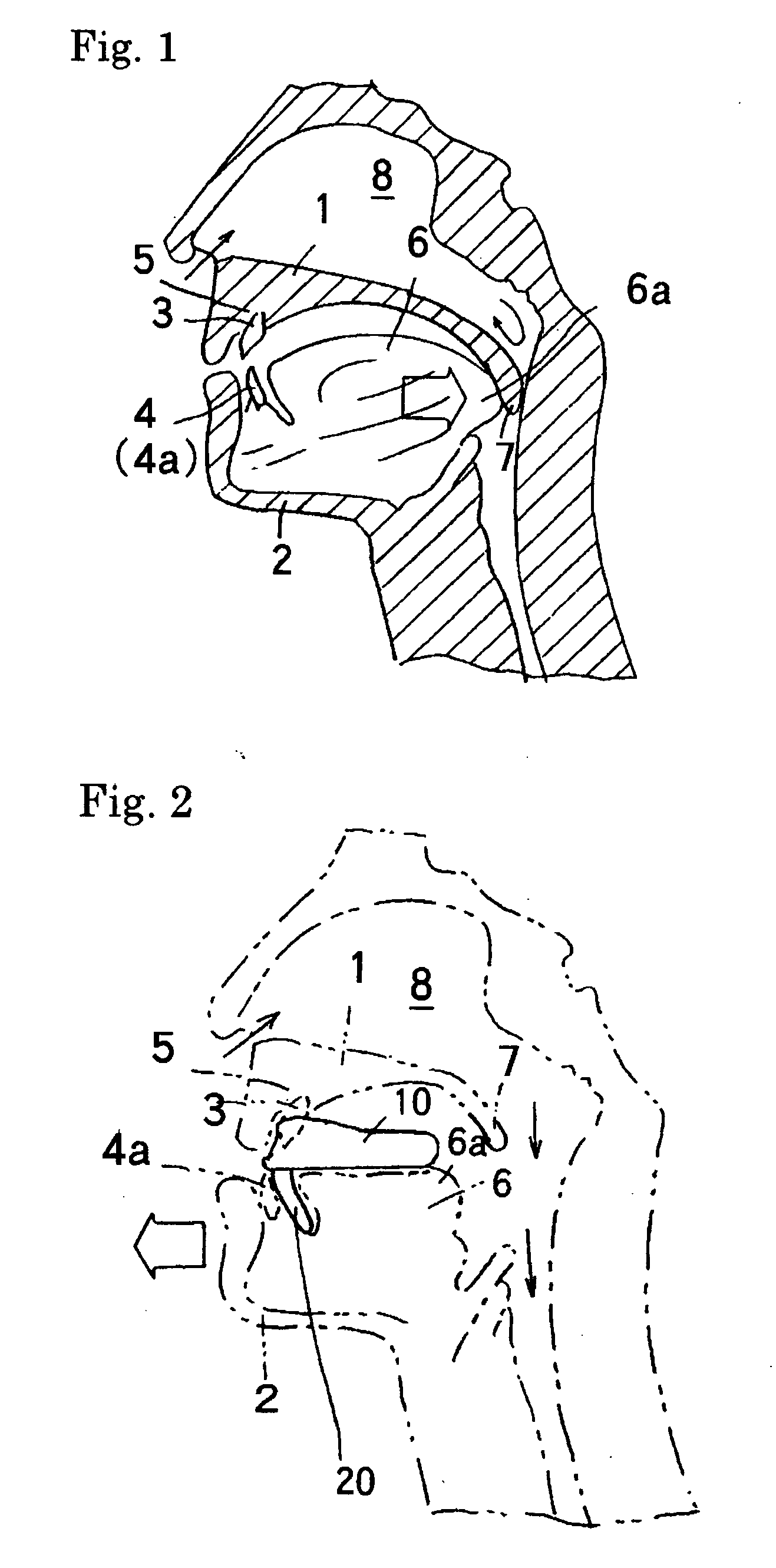 Snore and sleep apnea syndrome medical treatment device
