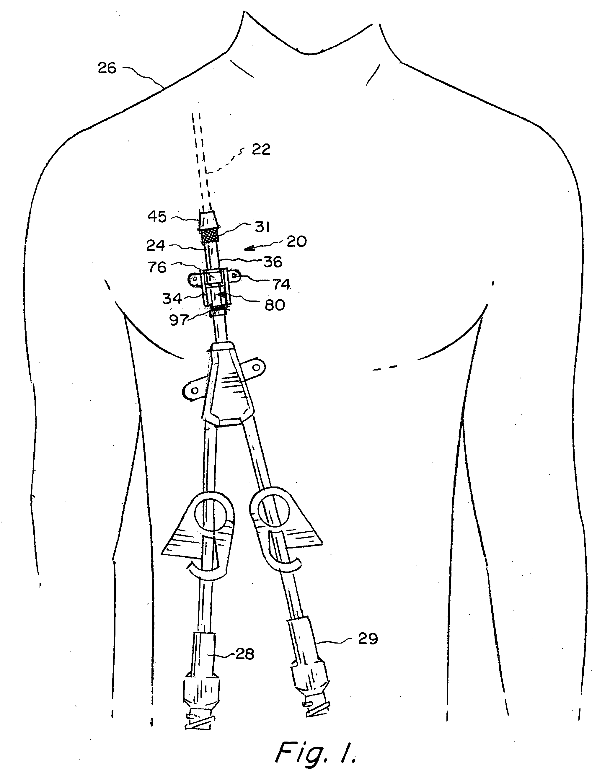 Enhanced apparatus for percutaneous catheter implantation and replacement