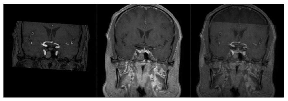 Intracranial vascular focus marking and three-dimensional display system based on smart medical treatment