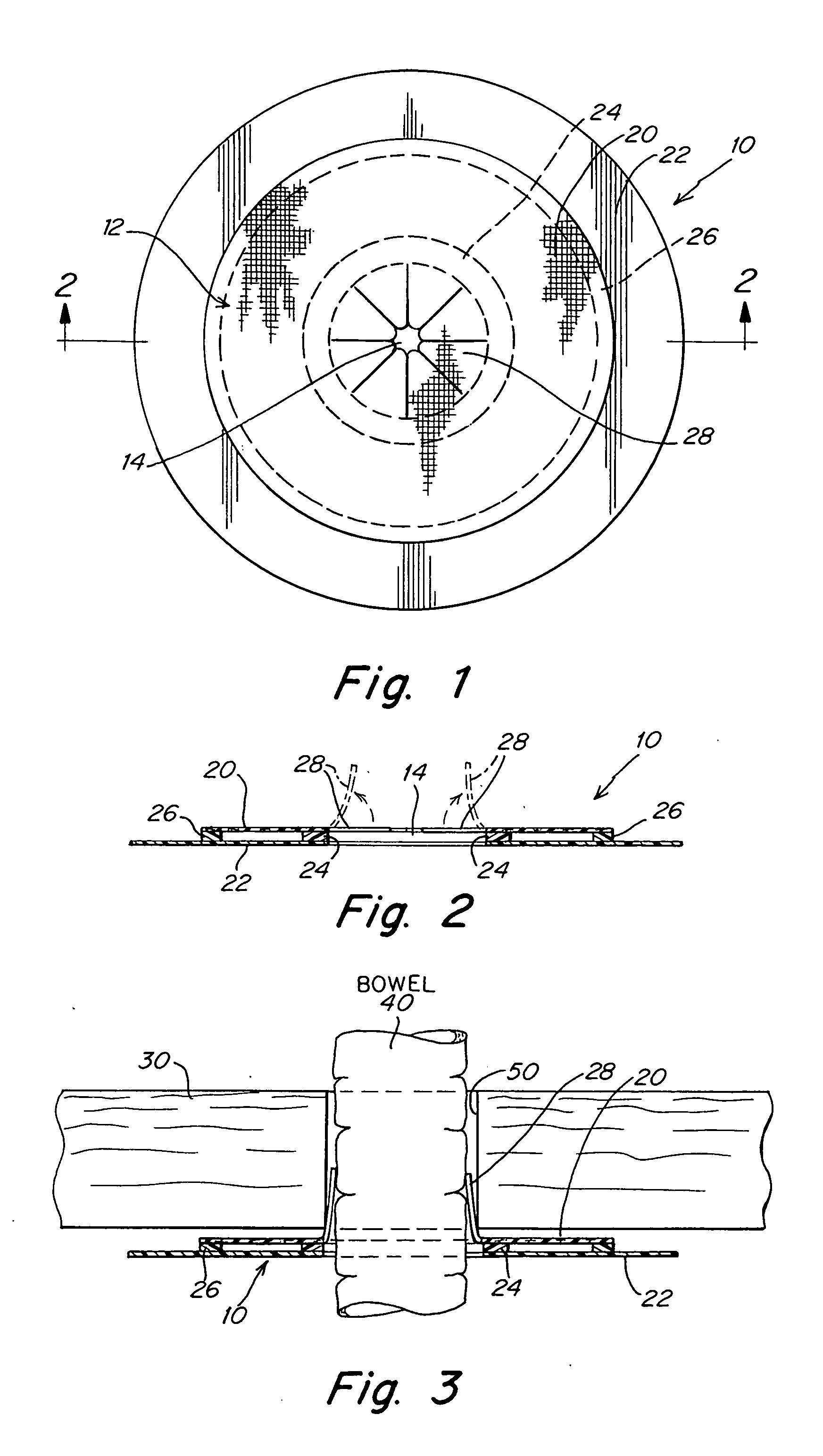 Implantable prosthesis and method of use