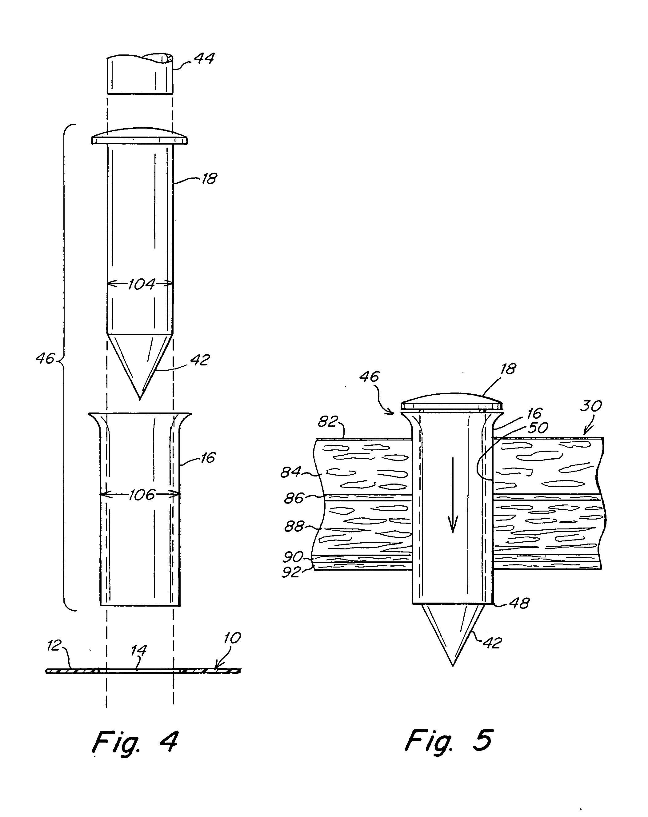 Implantable prosthesis and method of use
