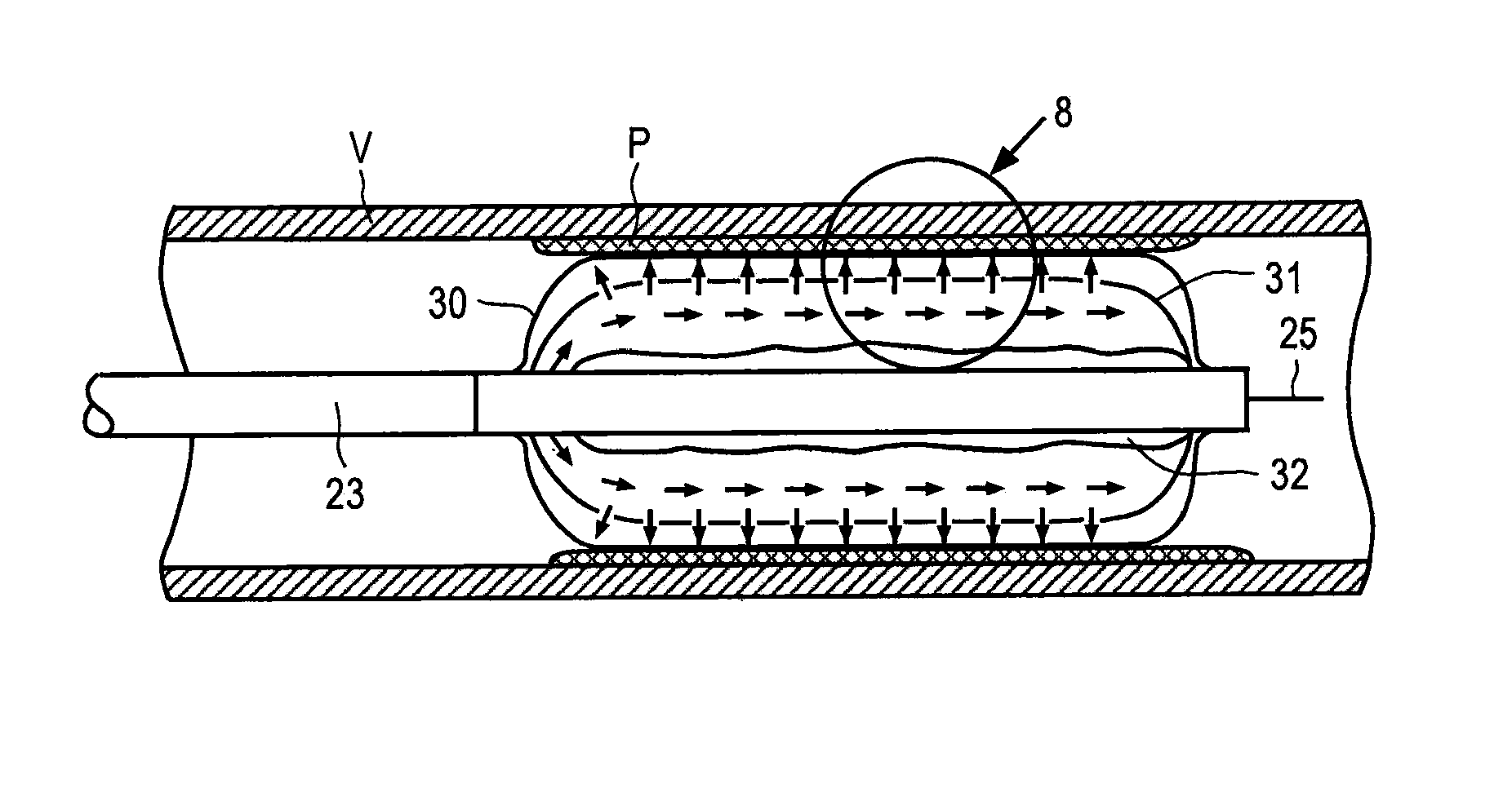 Apparatus and method for delivering intraluminal therapy
