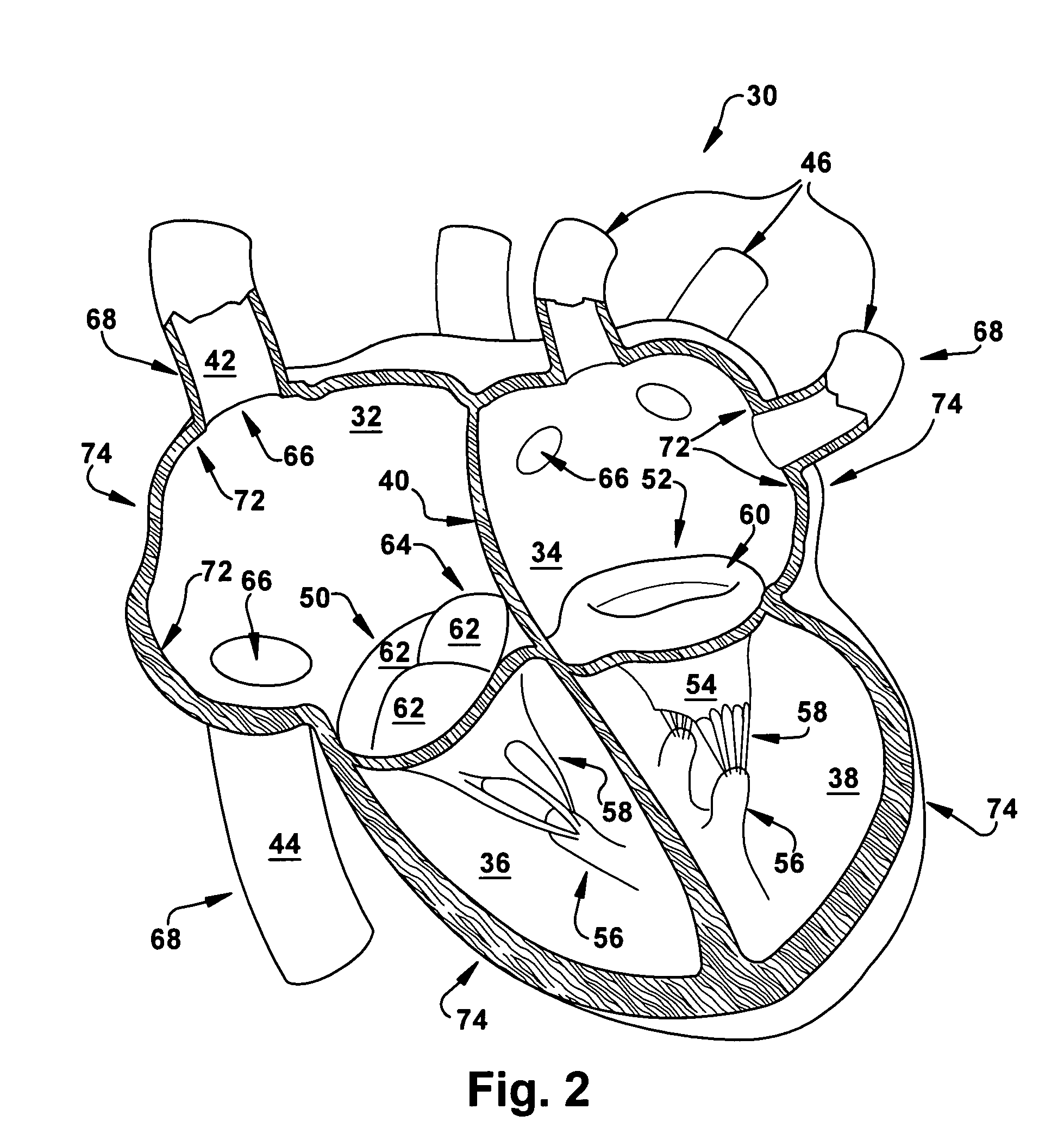 Apparatus and method for treating cardiovascular diseases