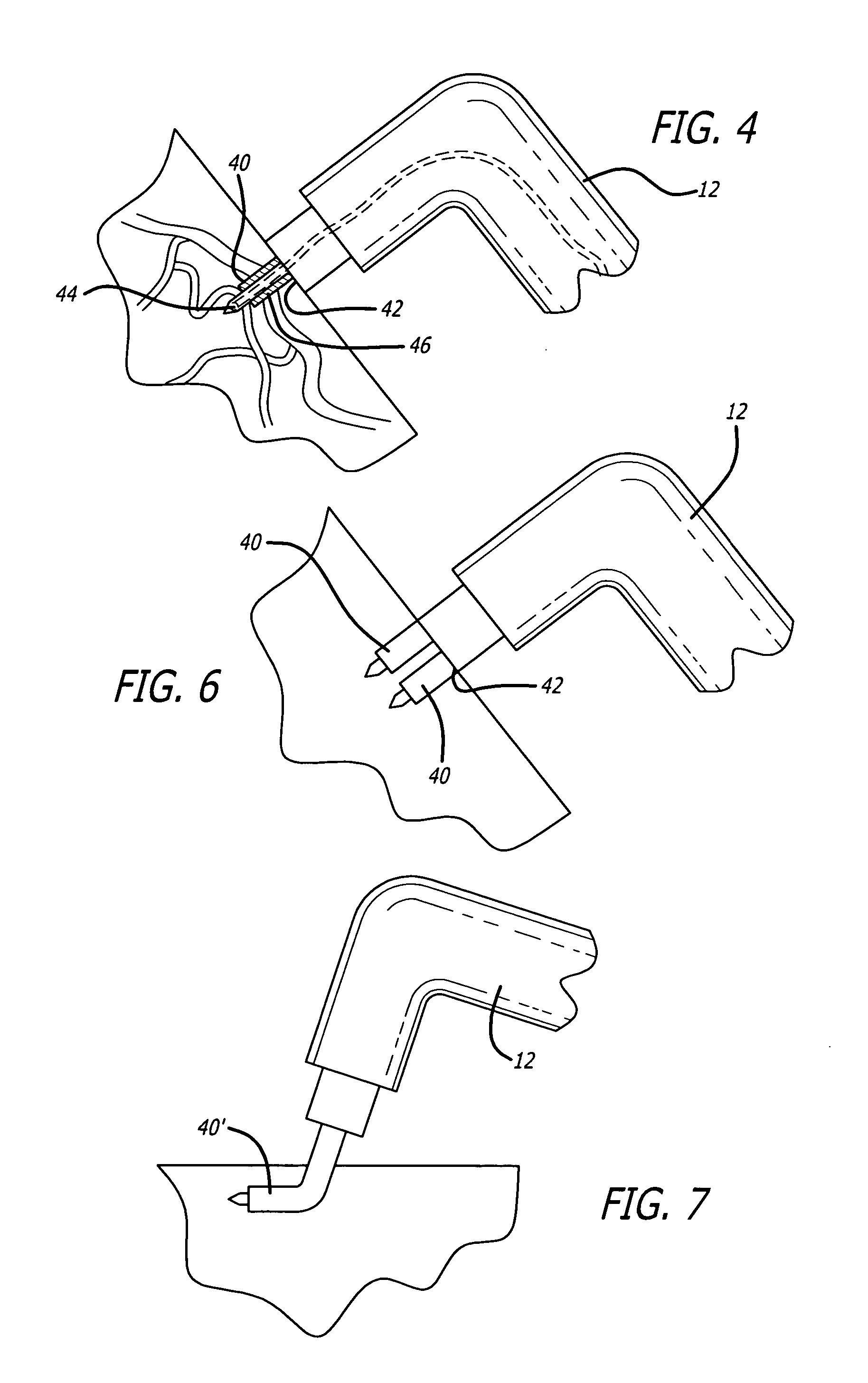 Method and apparatus to reduce wrinkles through application of radio frequency energy to nerves