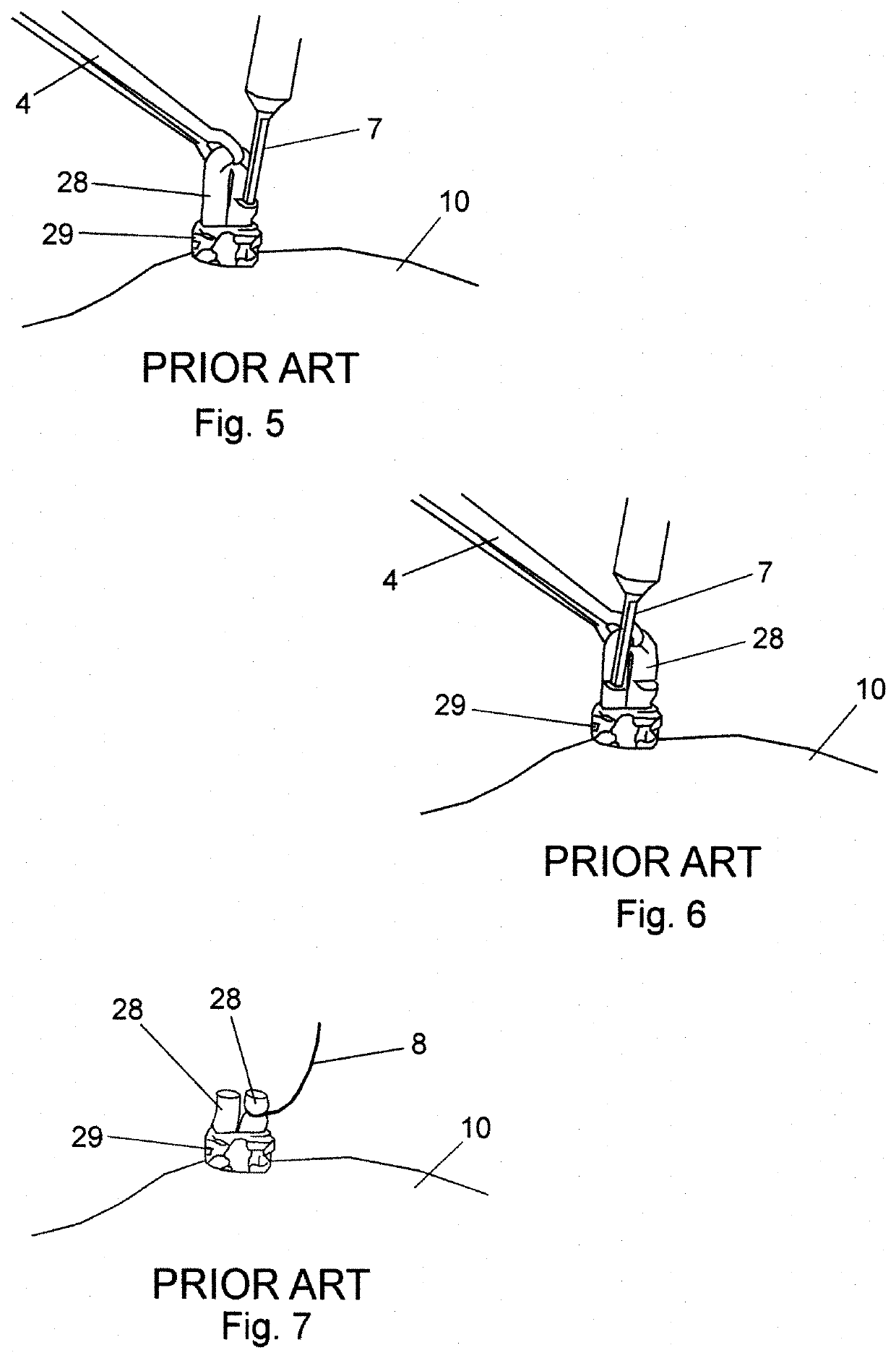 Vasectomy devices and methods for their use