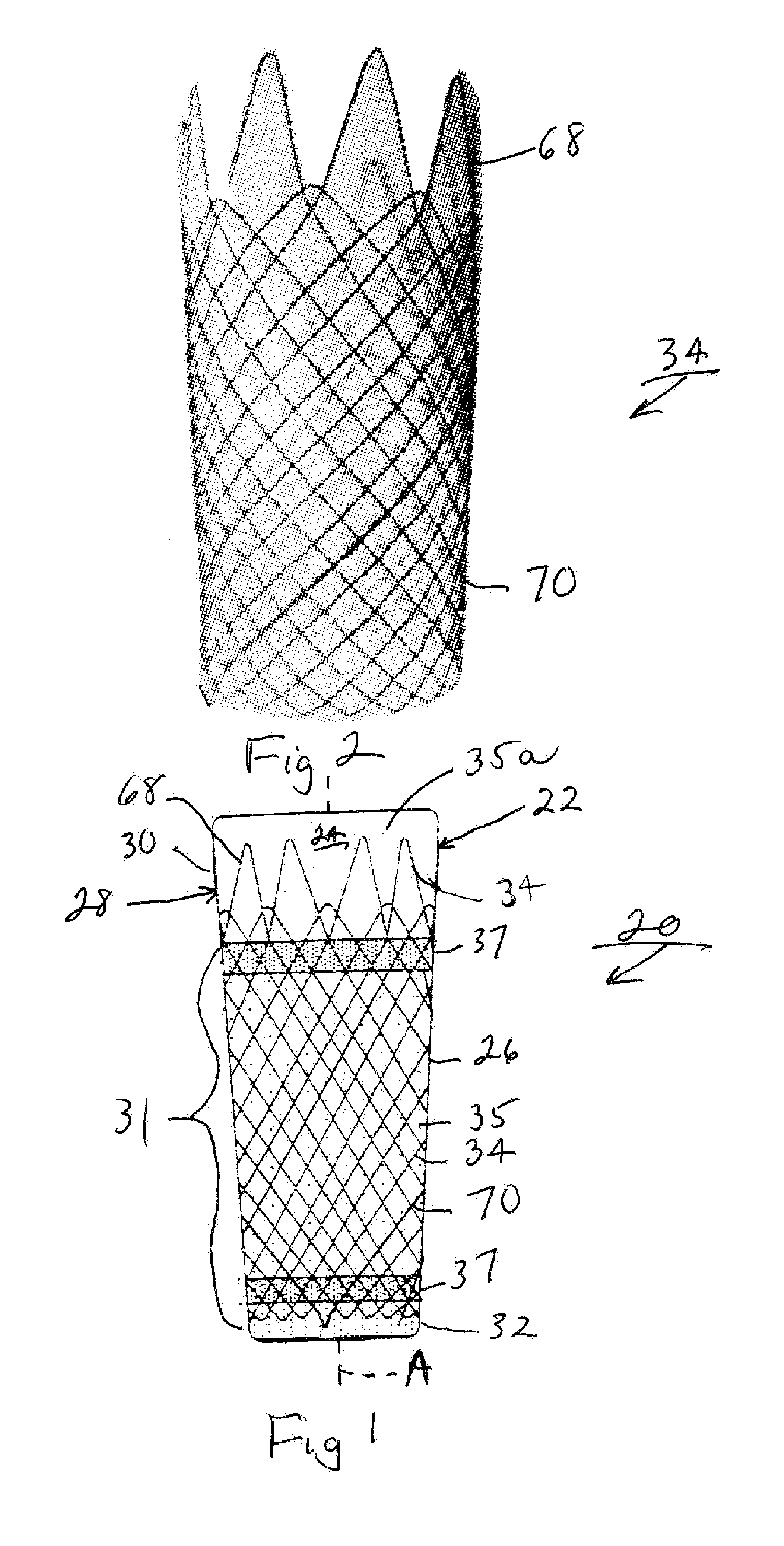 Intraluminal device and method