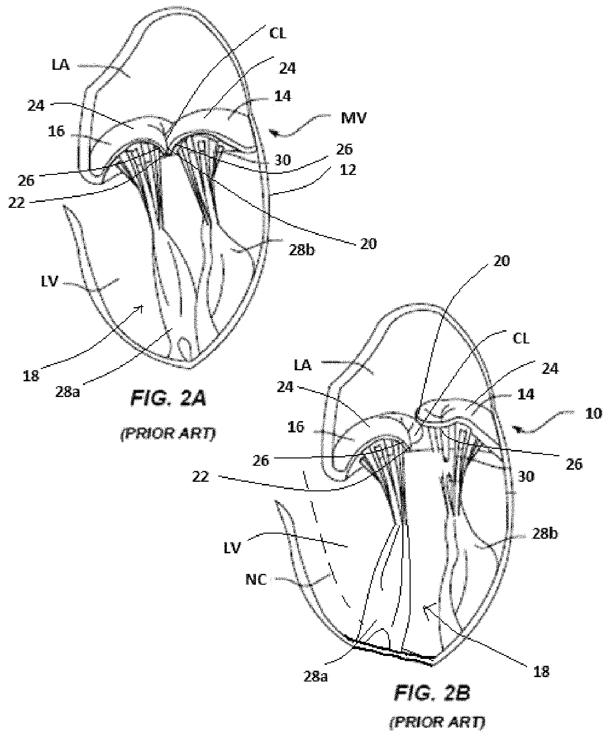 Heart valve with chordal capture elements for stabilization