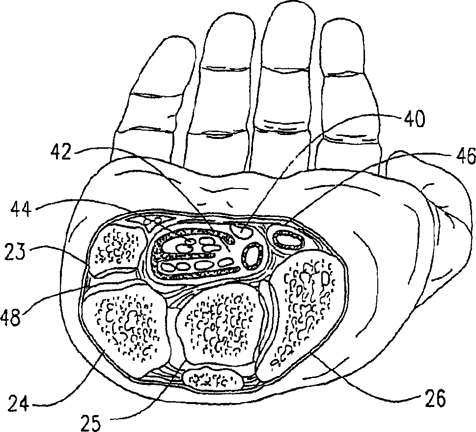 Co-dynamic adjustable orthotic appliance for carpal tunnel syndrome