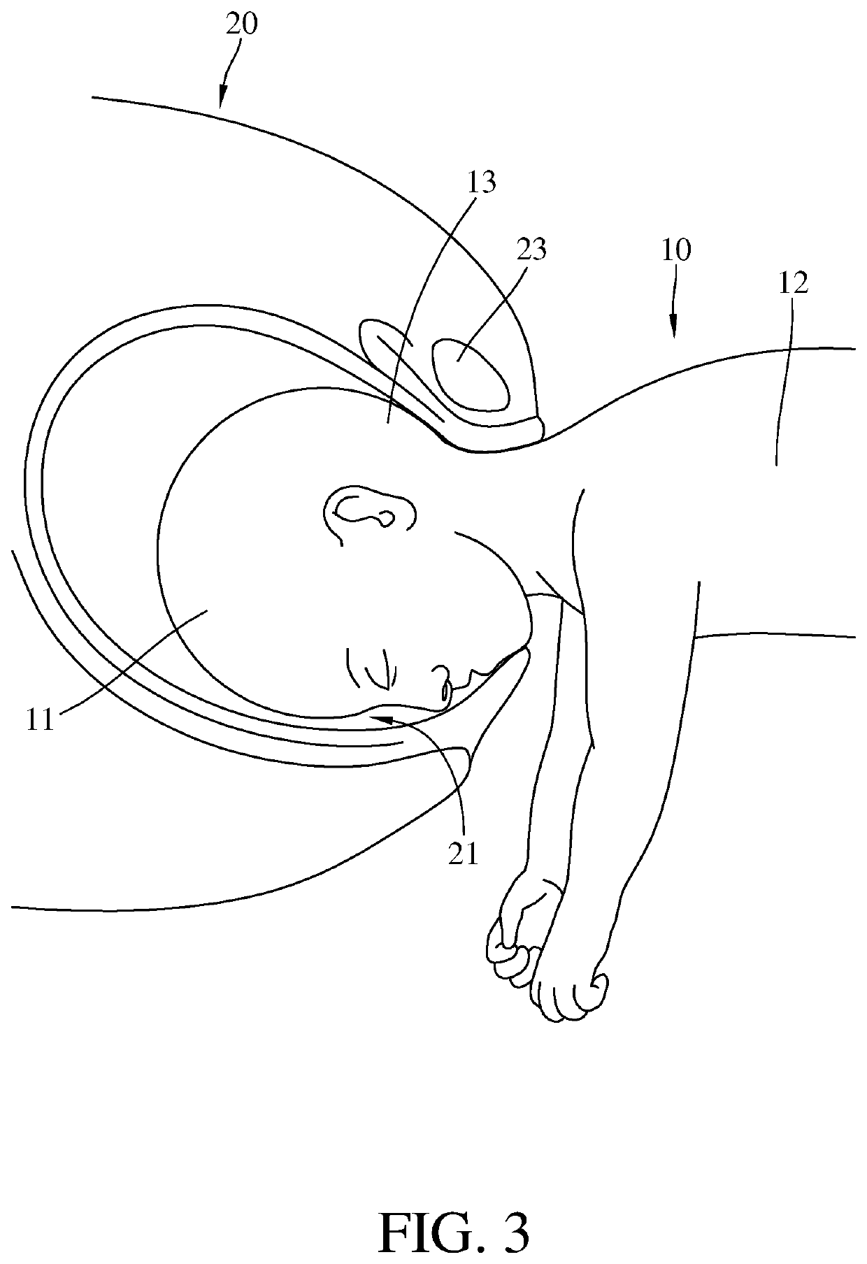 Delivery assistance device for vaginal breech delivery