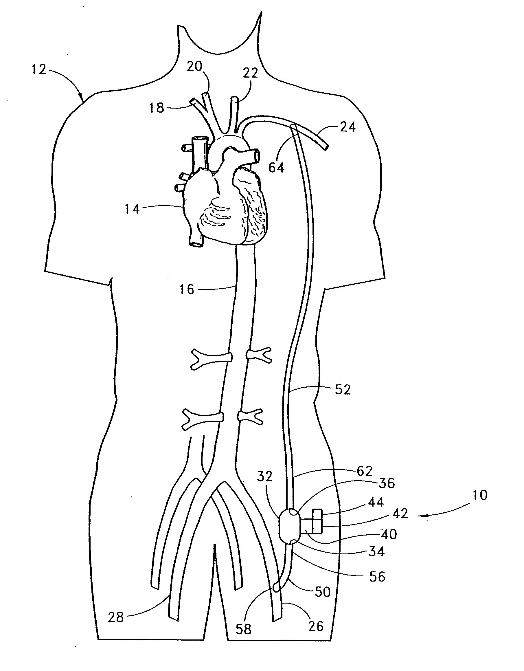 Implantable heart assist system and method of applying same