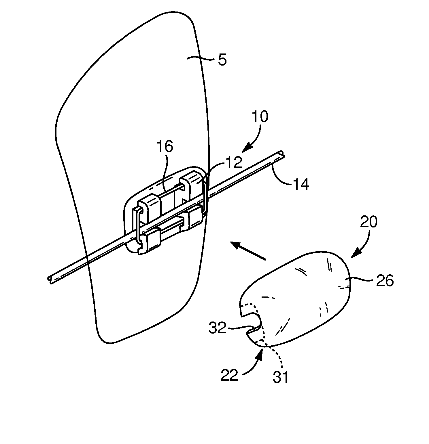 Devices, systems, and methods for orthodontic hardware