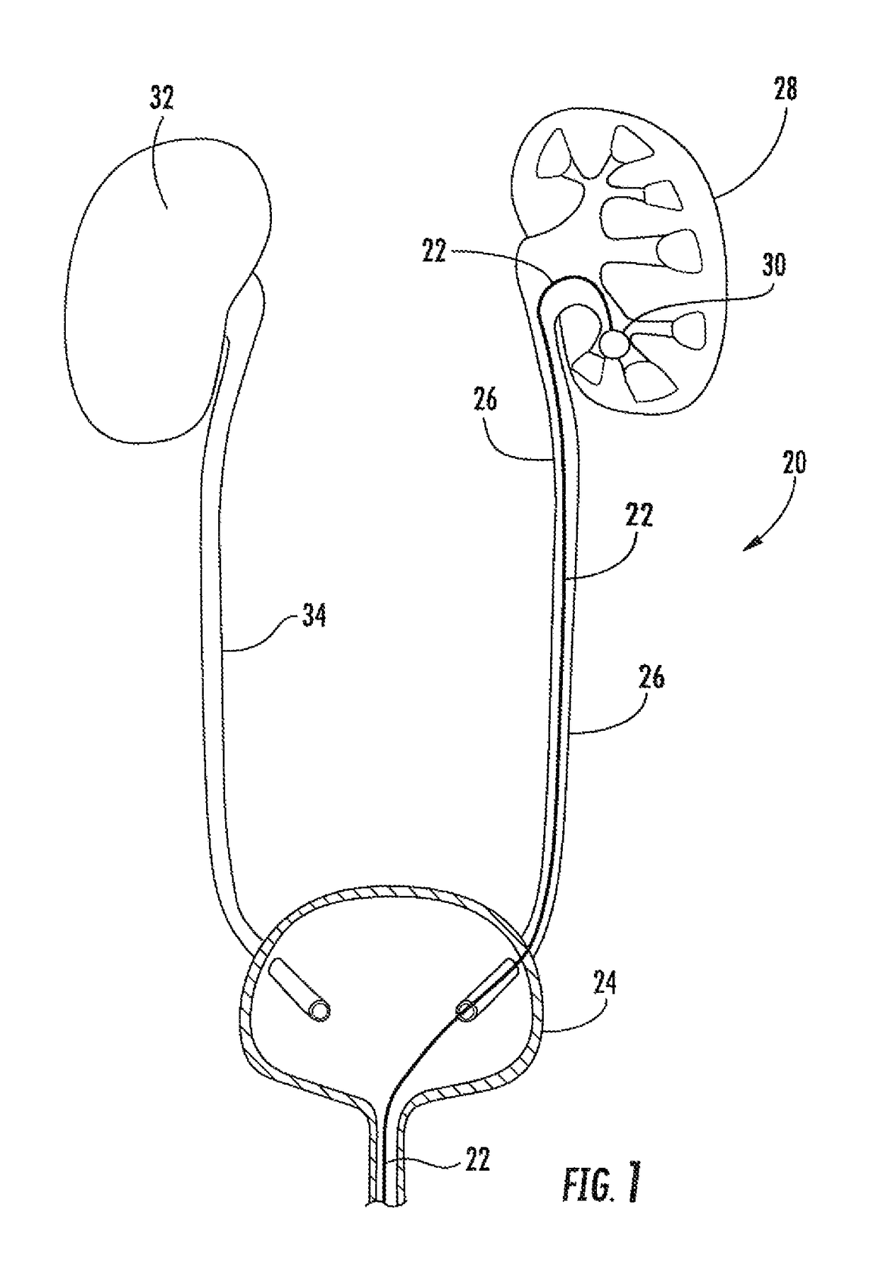 System for TFL lithotripsy, including endoscope with detachable and replaceable wave guide and method for use