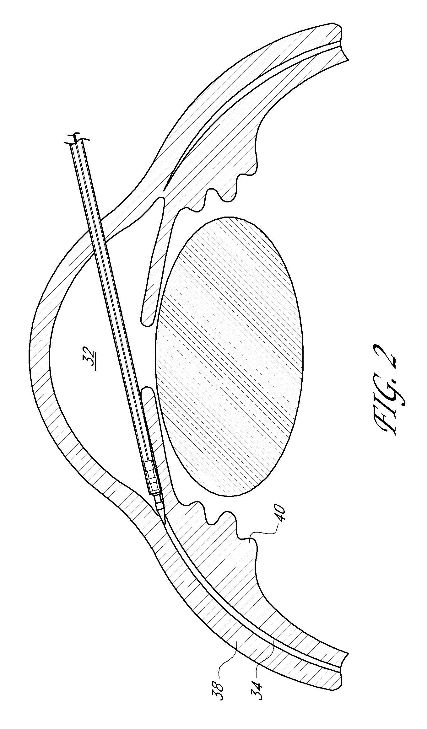 Uveoscleral shunt and methods for implanting same