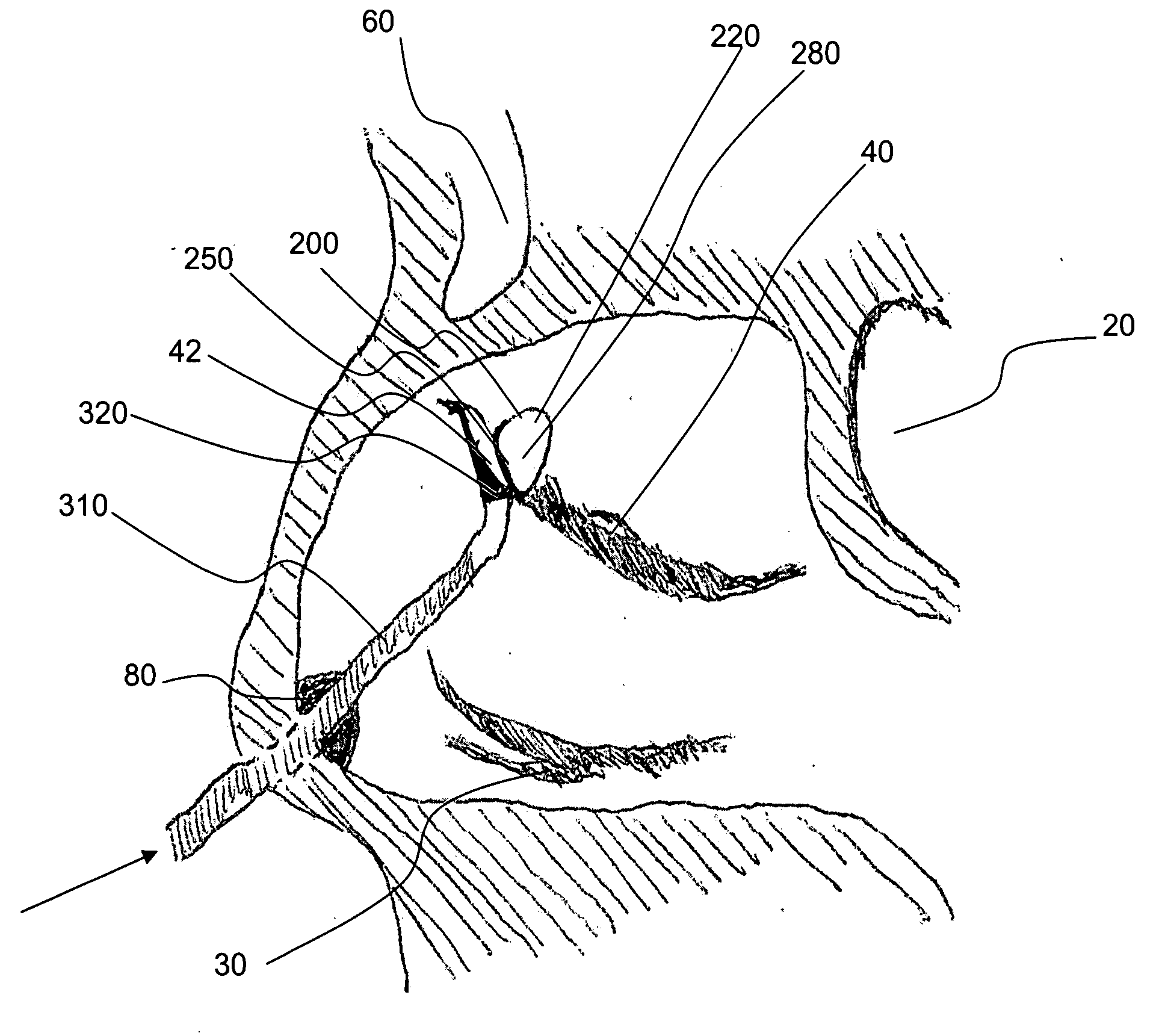 Methods and devices for ostium measurement