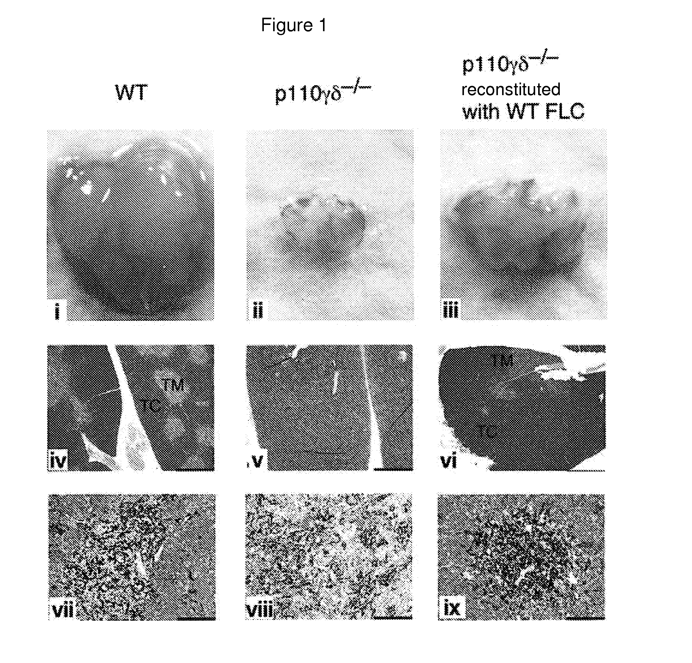 Methods and pharmaceutical compositions for treating lymphoid malignancy