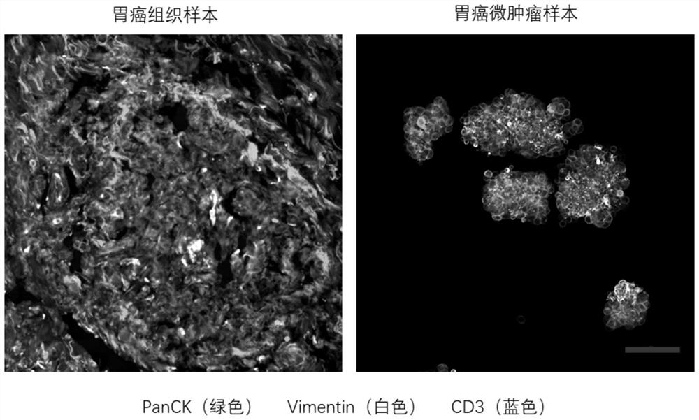 Culture method of gastric cancer micro-tumor cell model