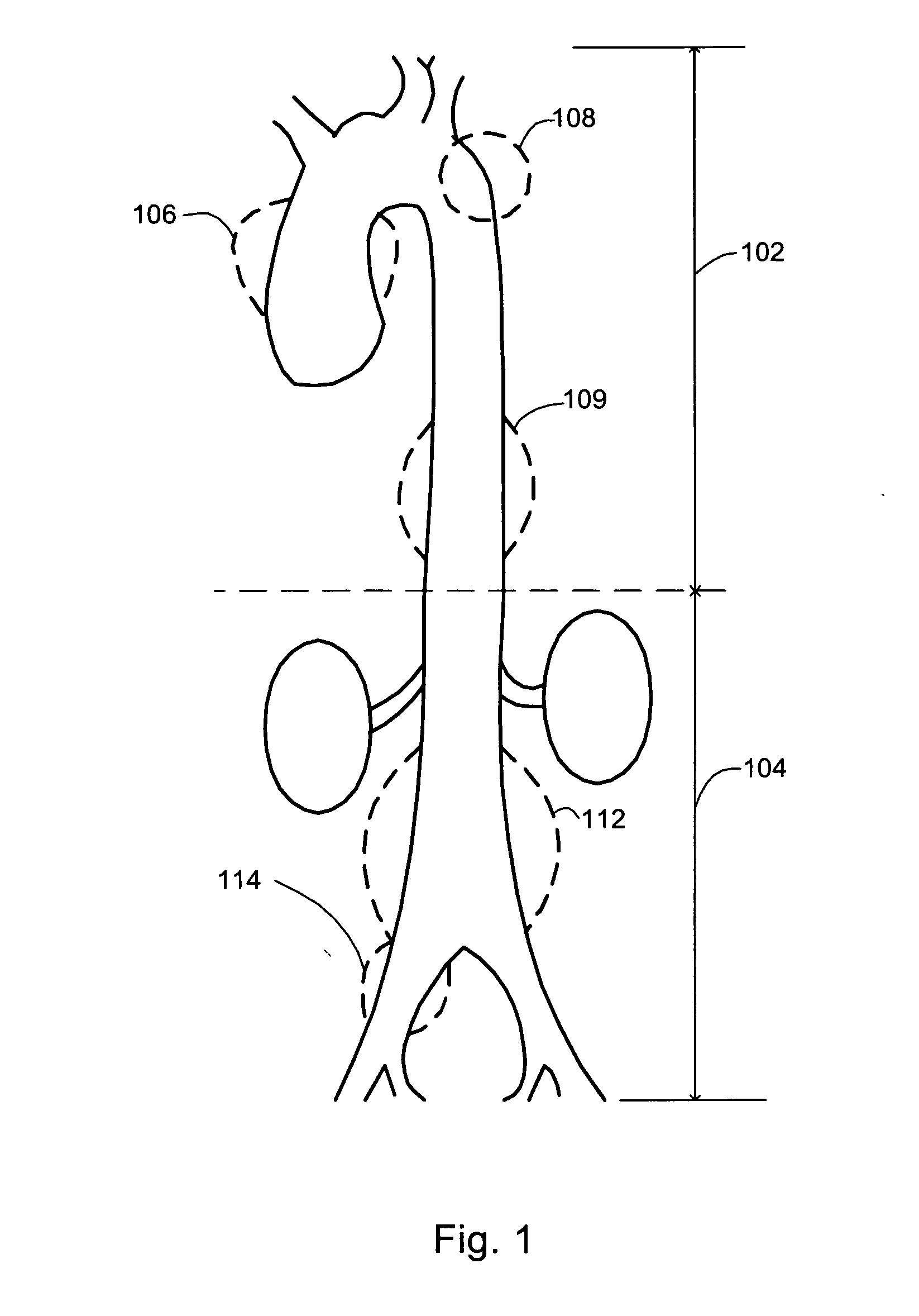 Methods and devices for extravascular intervention
